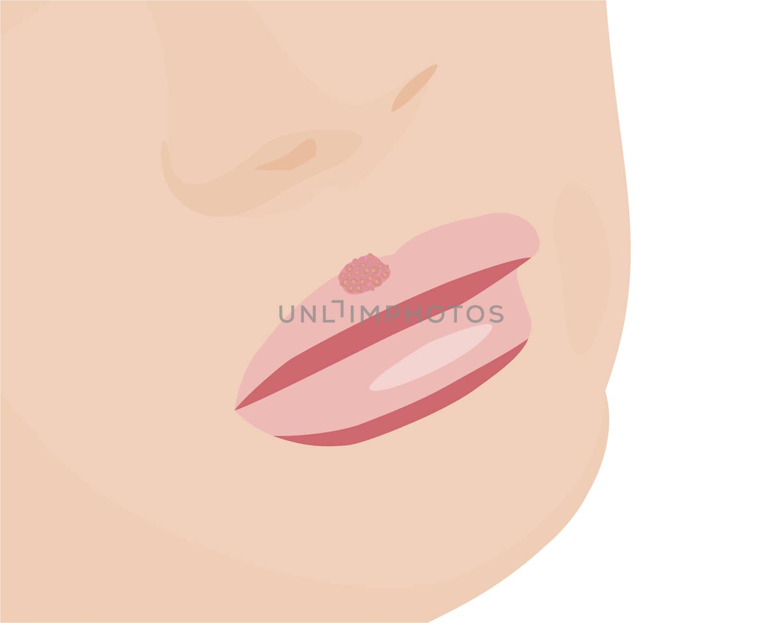 Blisters because of cold sores on lips vector illustration Virus infection skin care problem