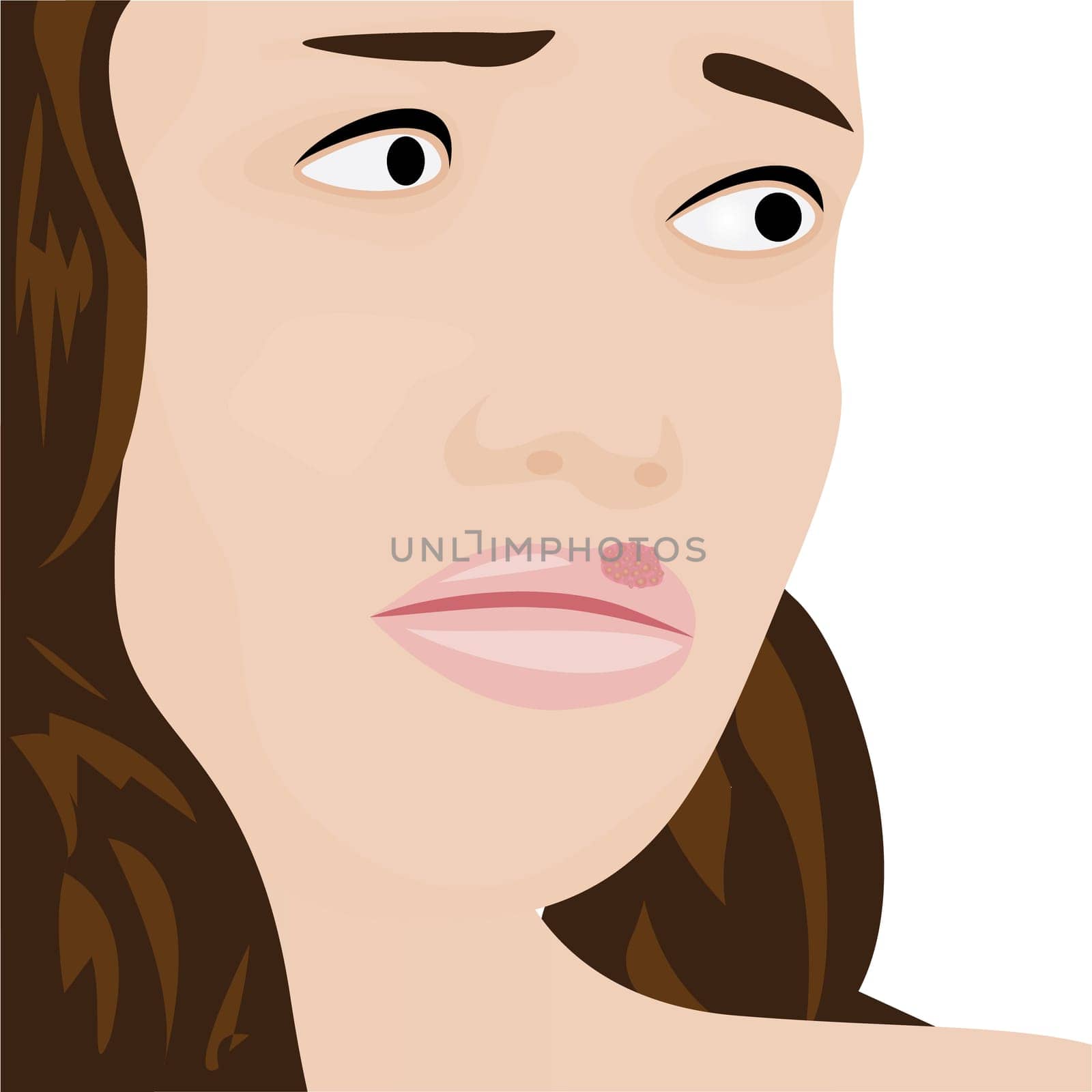 A young woman having cold sores herpes viral infection vector illustration