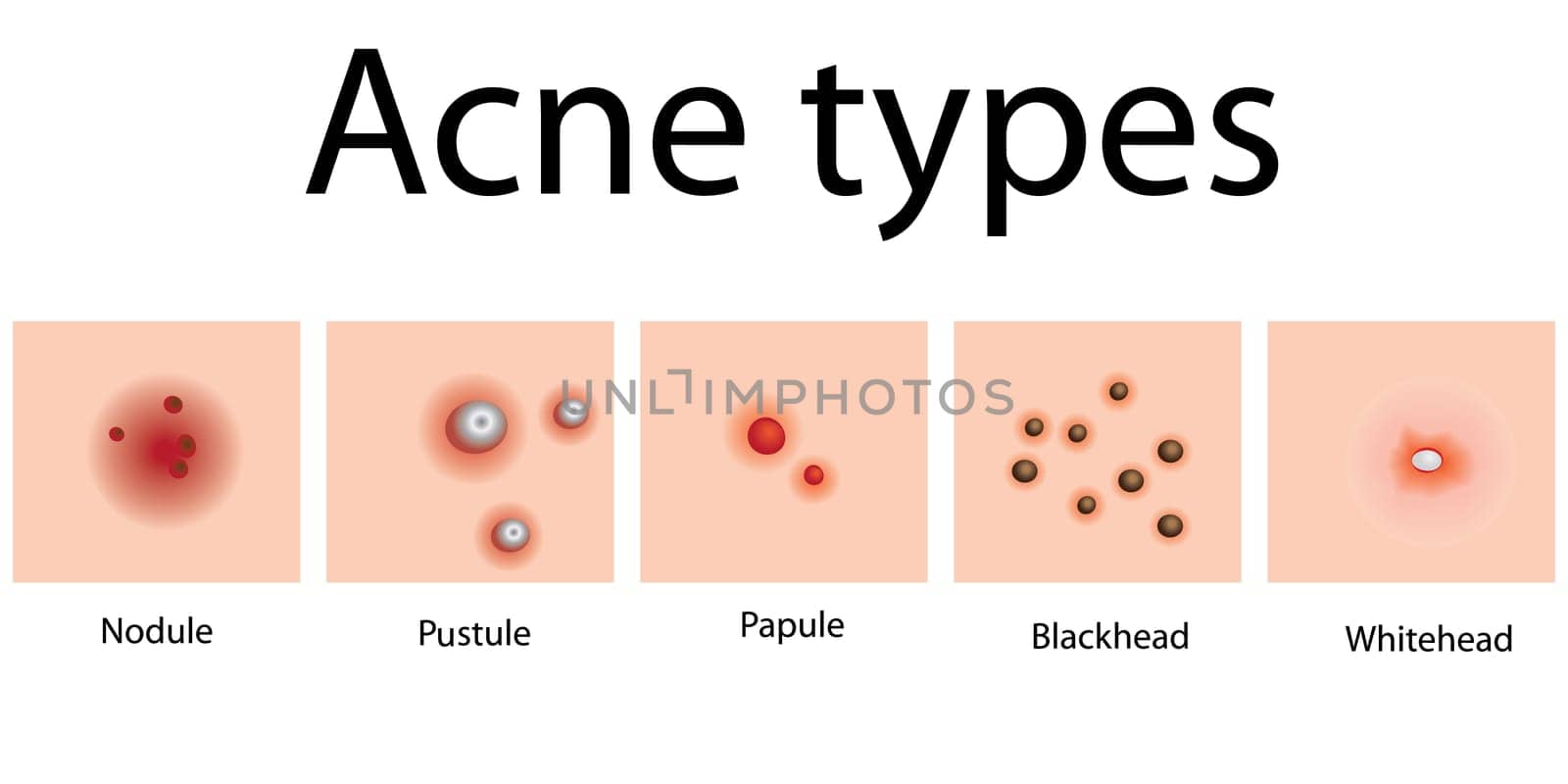 Acne types of problem skin dermatology vector illustration