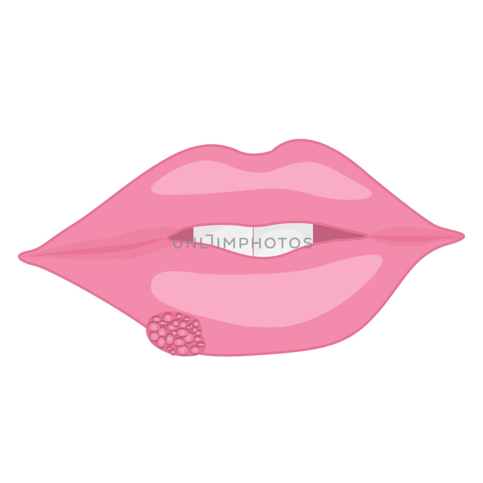 A mouth with Cold sores on lips vector illustration on a white background isolated Health care concept viral contagious infection
