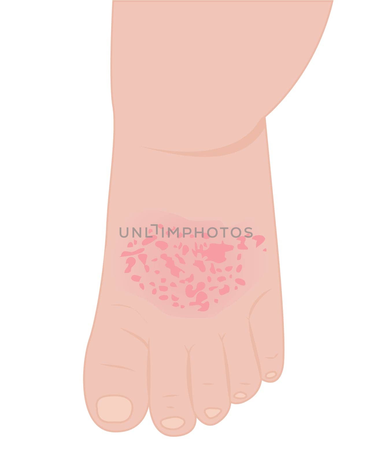 A baby foot affected with eczema vector illustration on a white background isolated