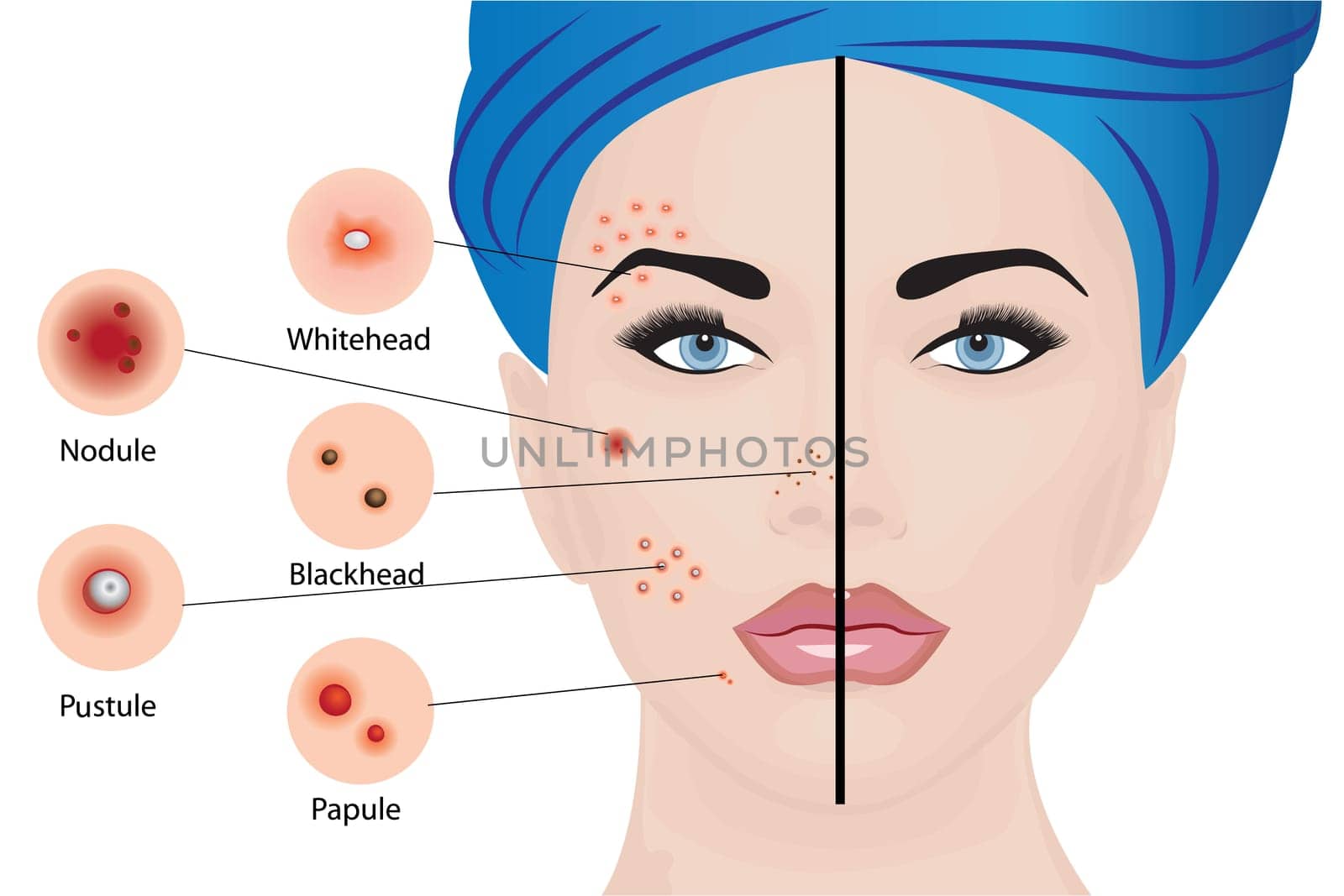 Acne types on a woman face vector illustration. Cosmetology concept, dermatology skin disease