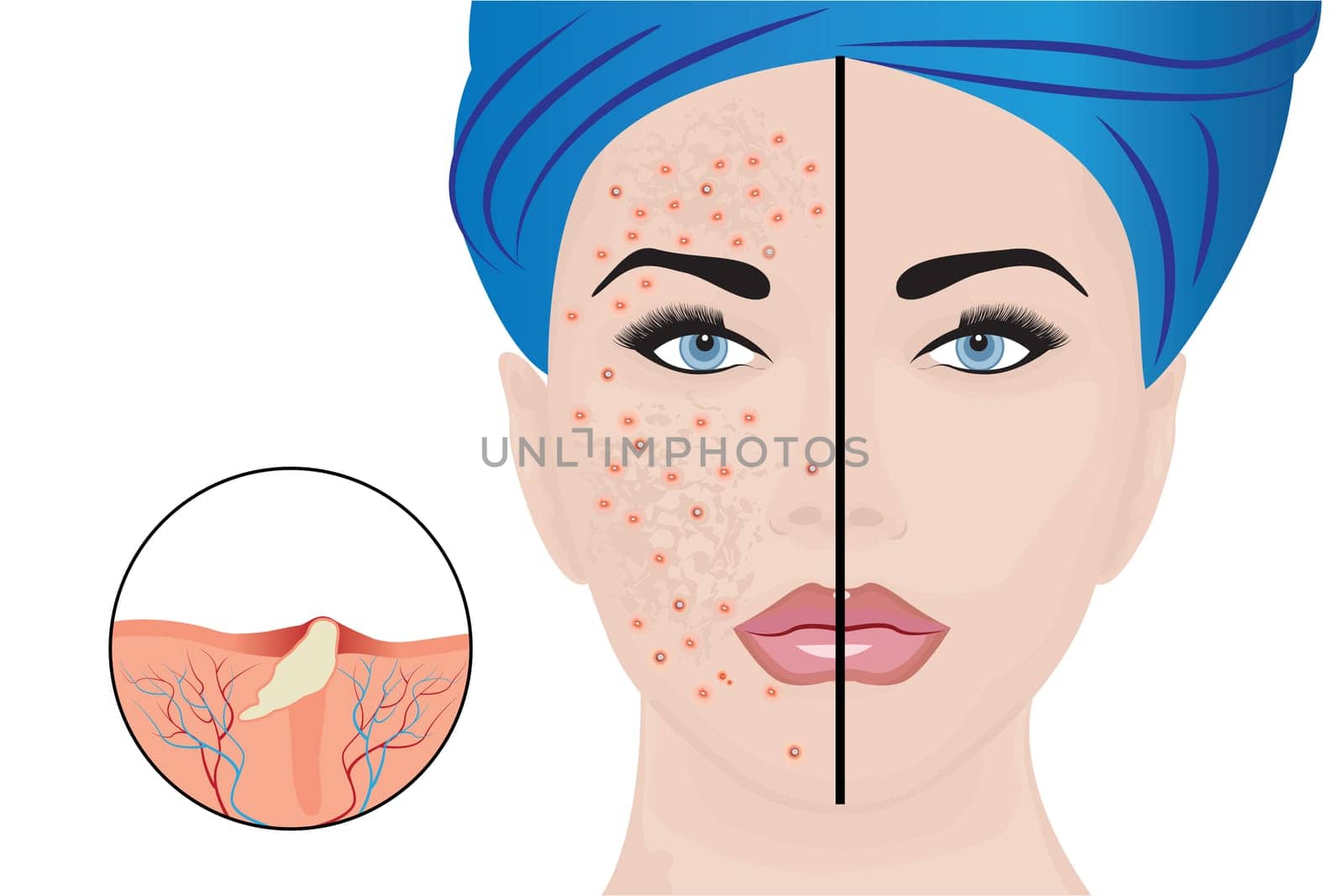 Acne pustules on a woman face and a treatment result before and after. vector illustration. Cosmetology concept, dermatology skin disease