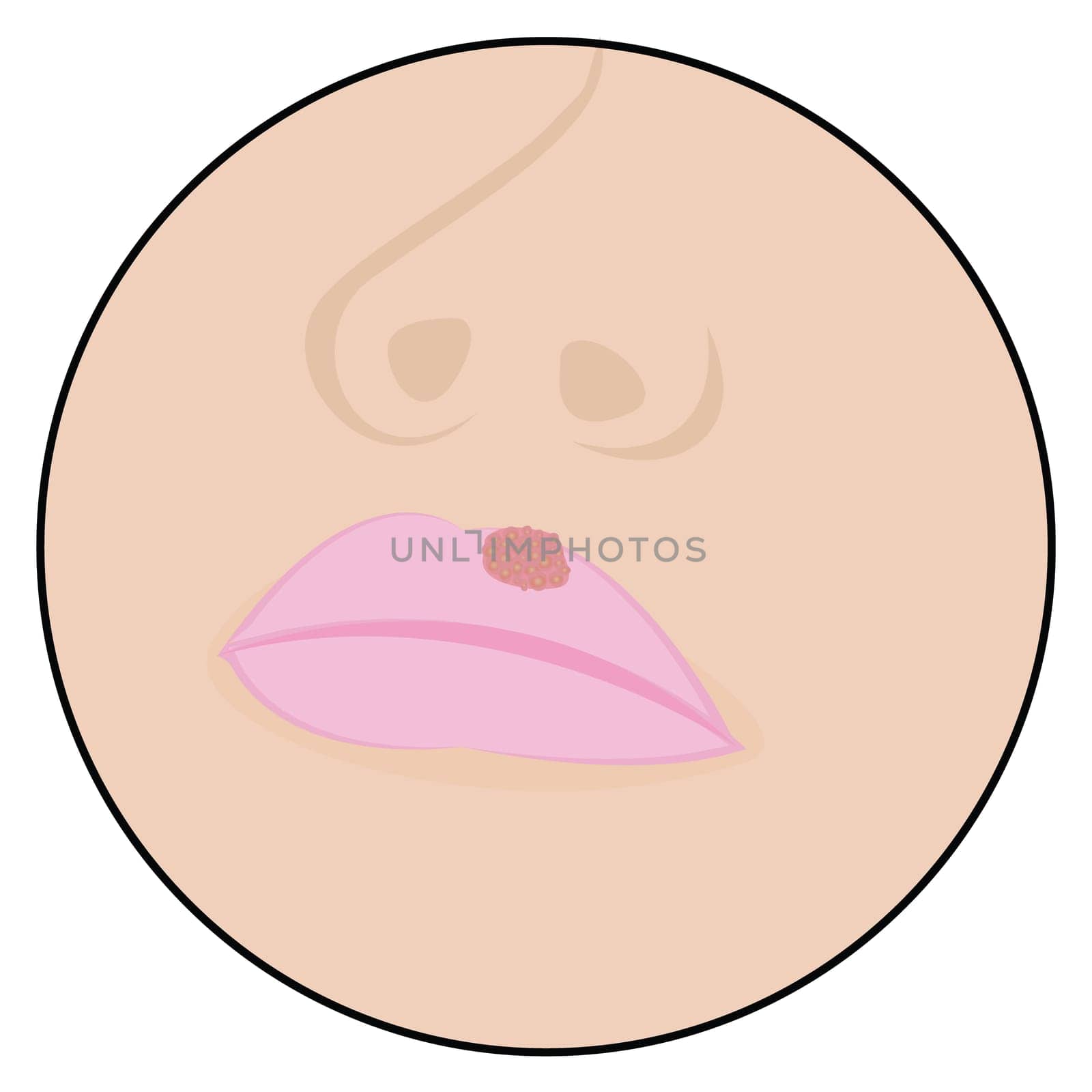 Herpes on lips cold sores viral infection vector illustration
