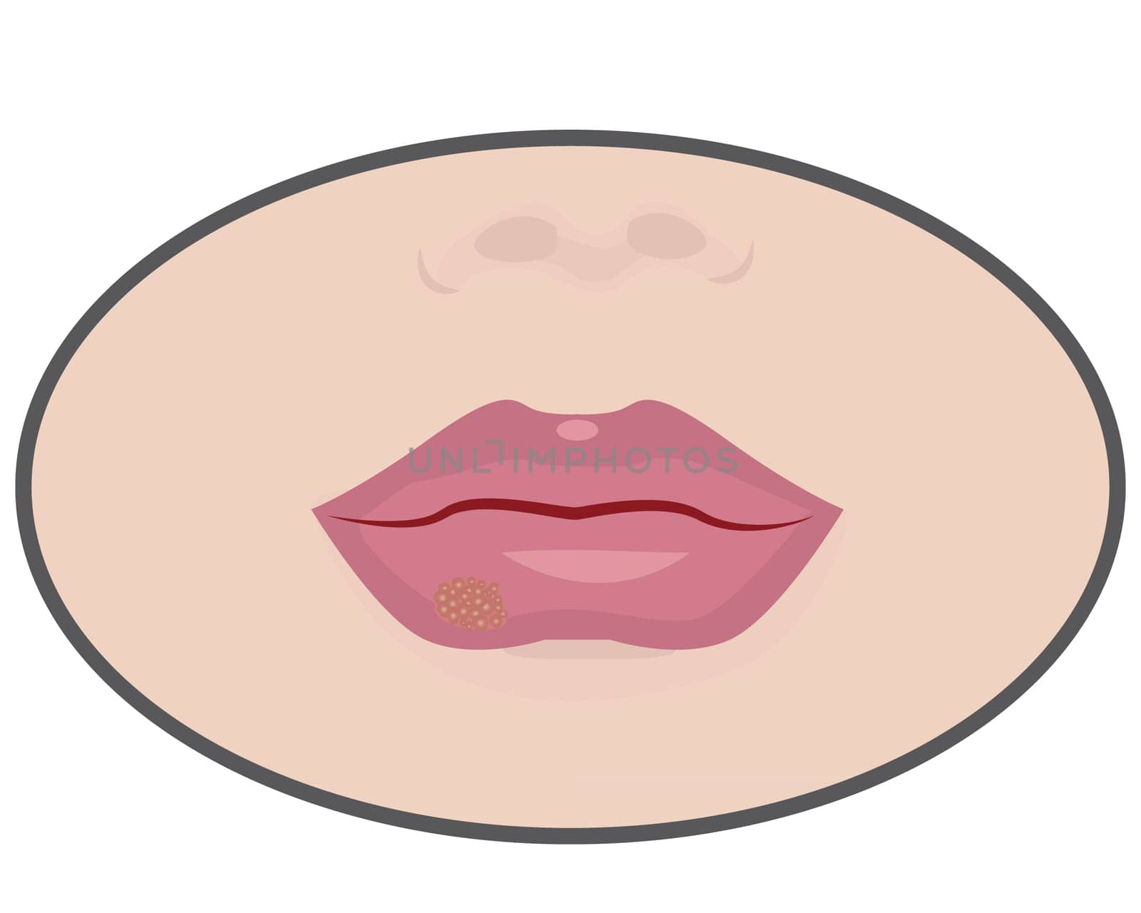 Herpes on lips cold sores viral infection vector illustration isolated on a white background
