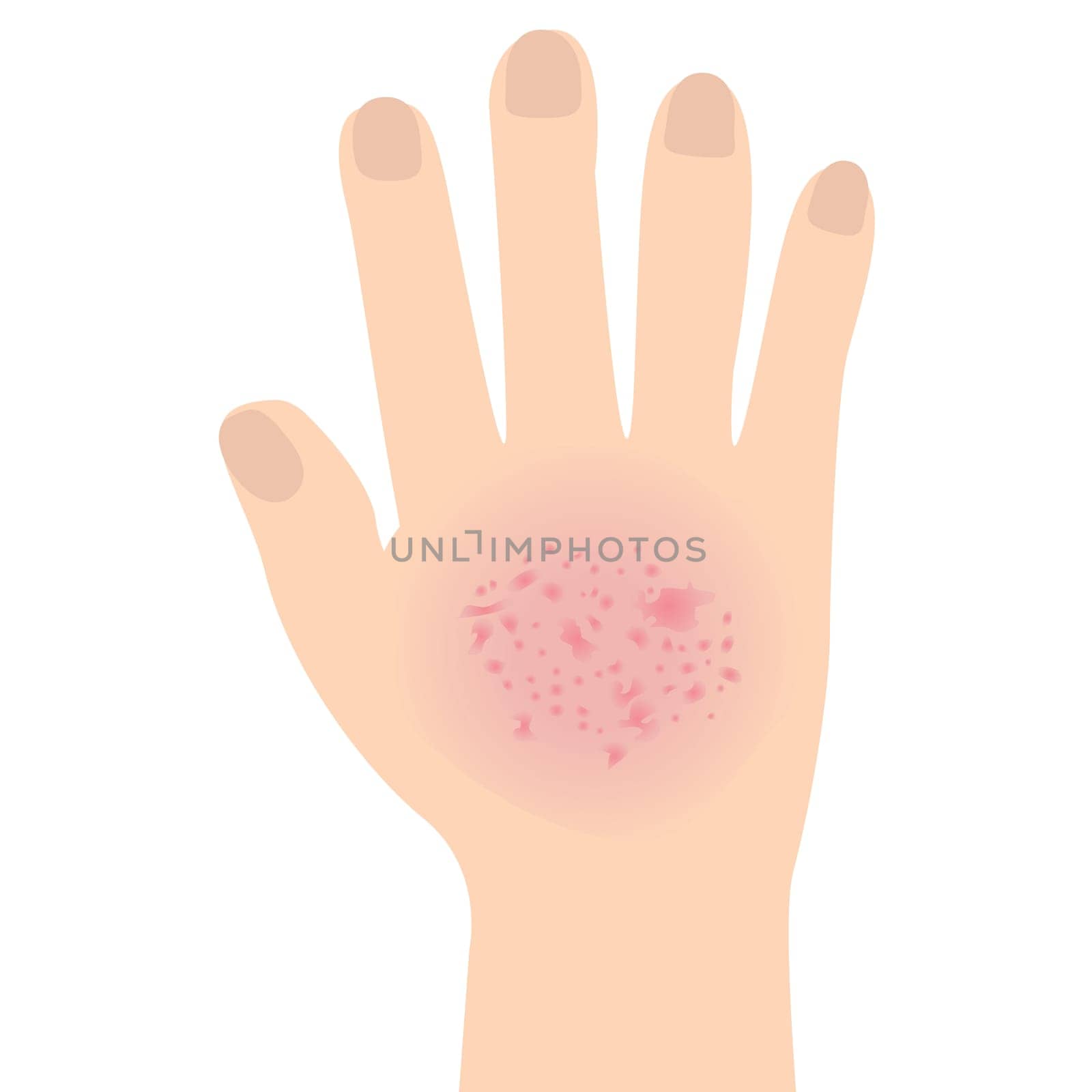 Eczema affected a hand Dermatology skin disease concept vector illustration on a white background isolated