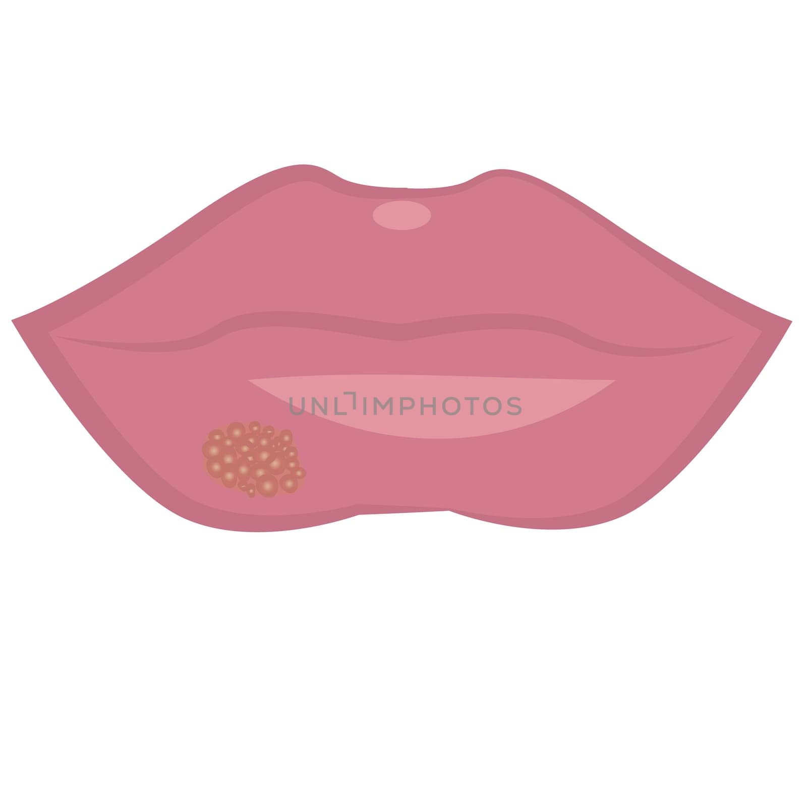 Herpes cold sores on lips vector illustration on a white background isolated