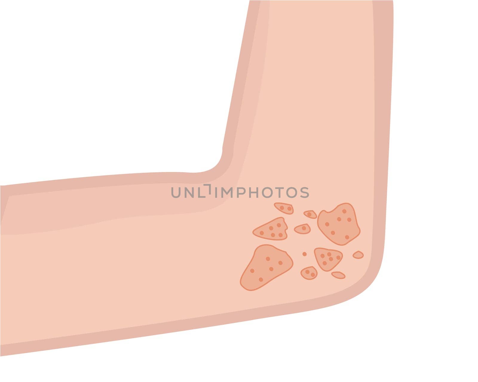 Person's elbow affected with eczema skin disease vector illustration Dermatology problem