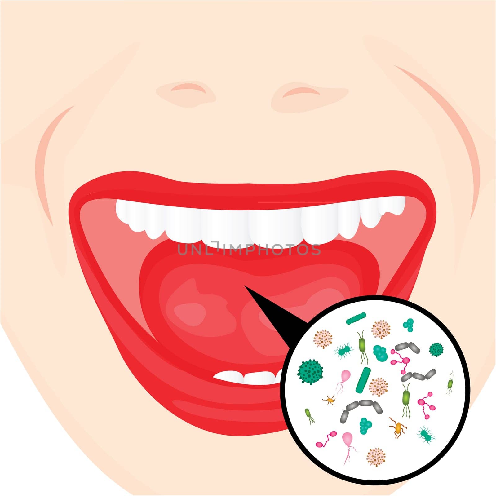 Bacterial overgrowth in a mouth. flu, cold, other contagious diseases vector illustration on a white background