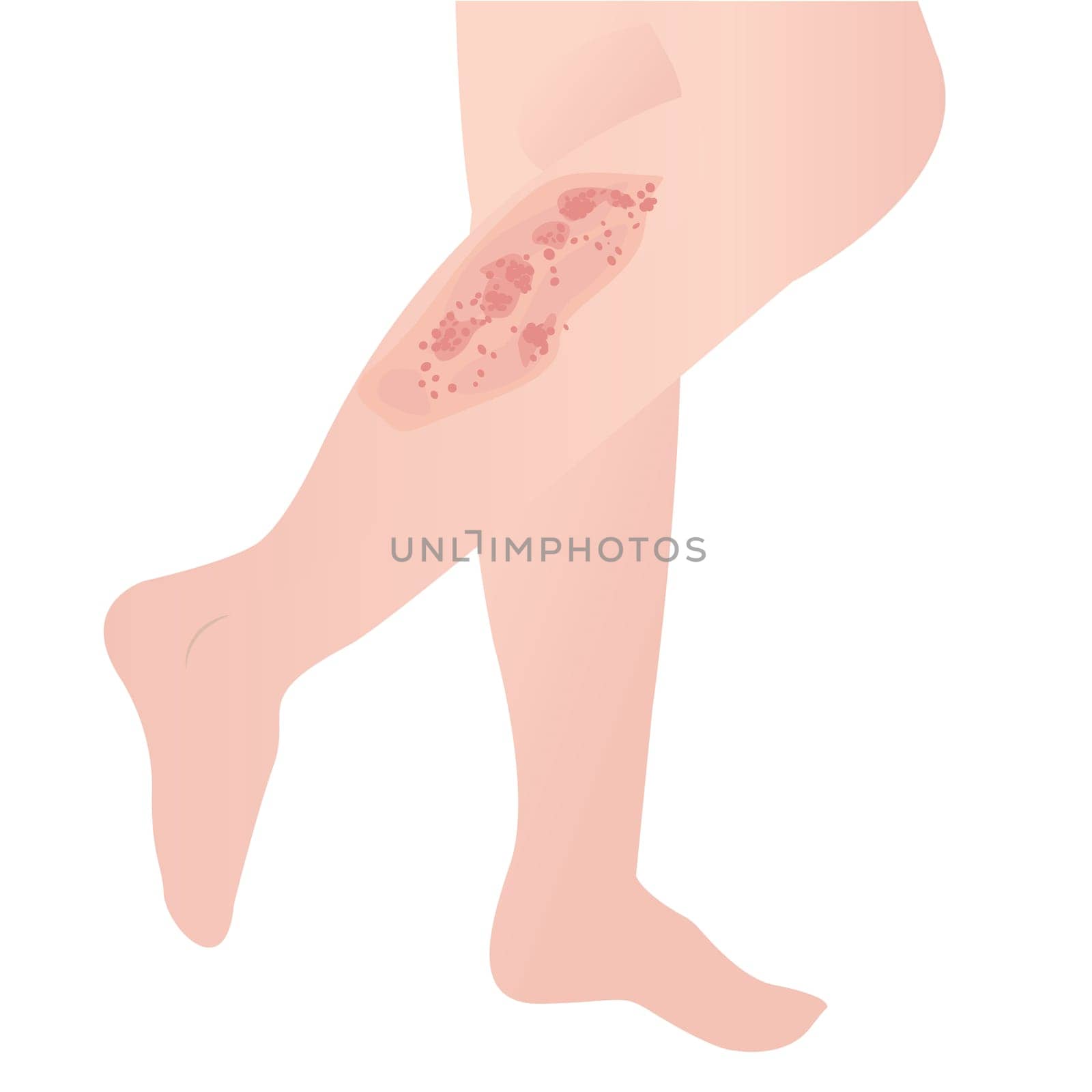 psoriasis skin disease on a white background vector illustration