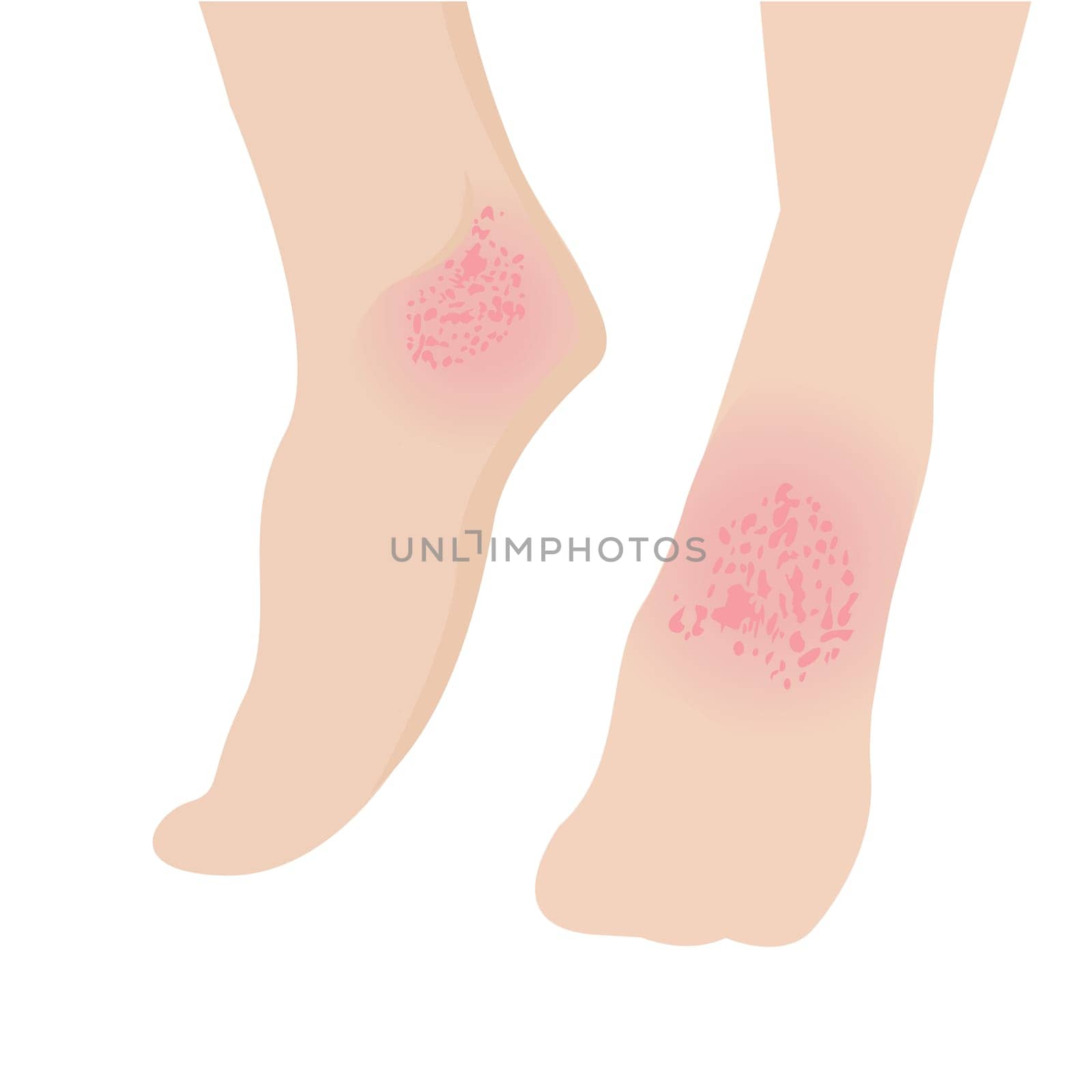 Eczema affected a foot Dermatology skin disease concept vector illustration on a white background isolated