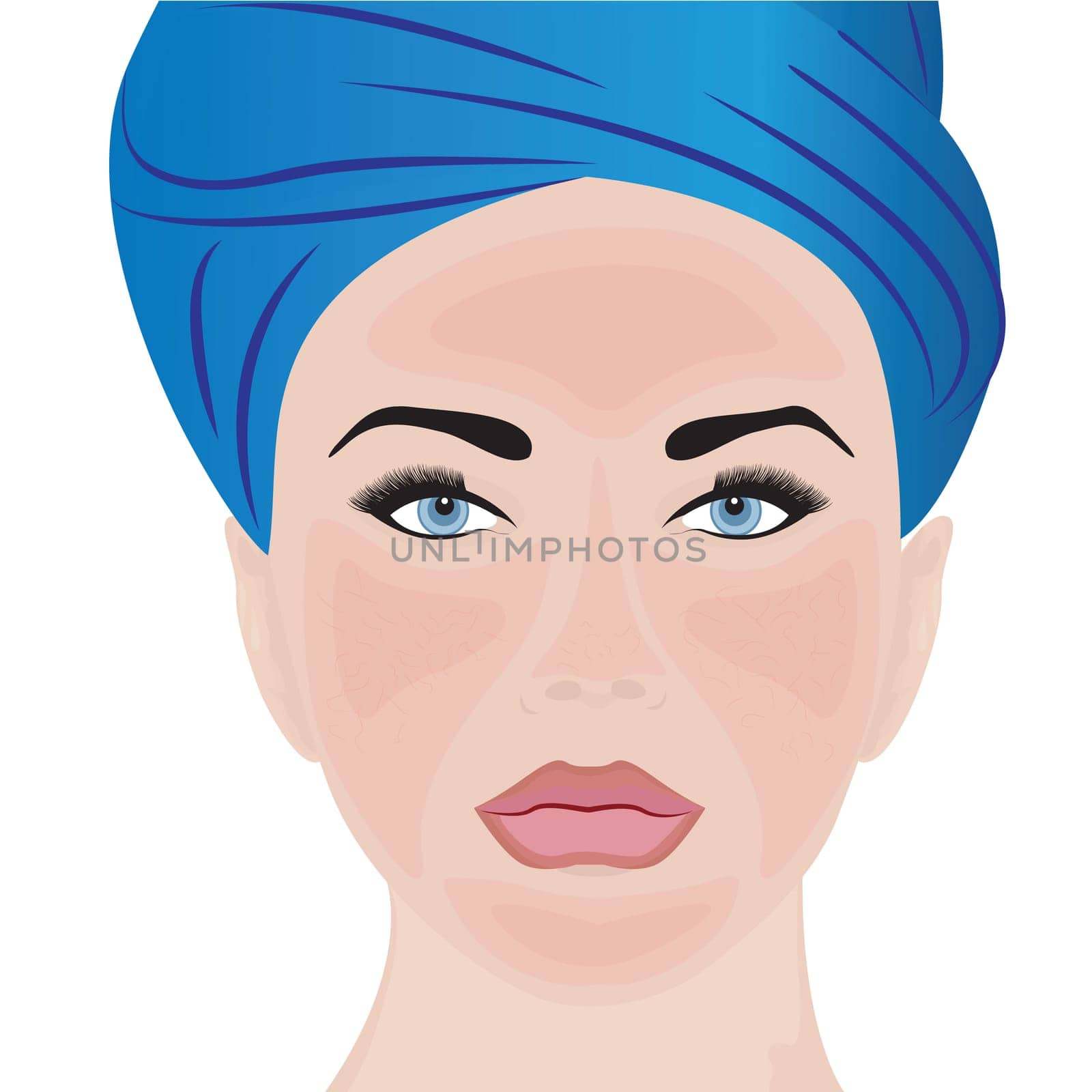 Rosacea mild on woman face vector illustration