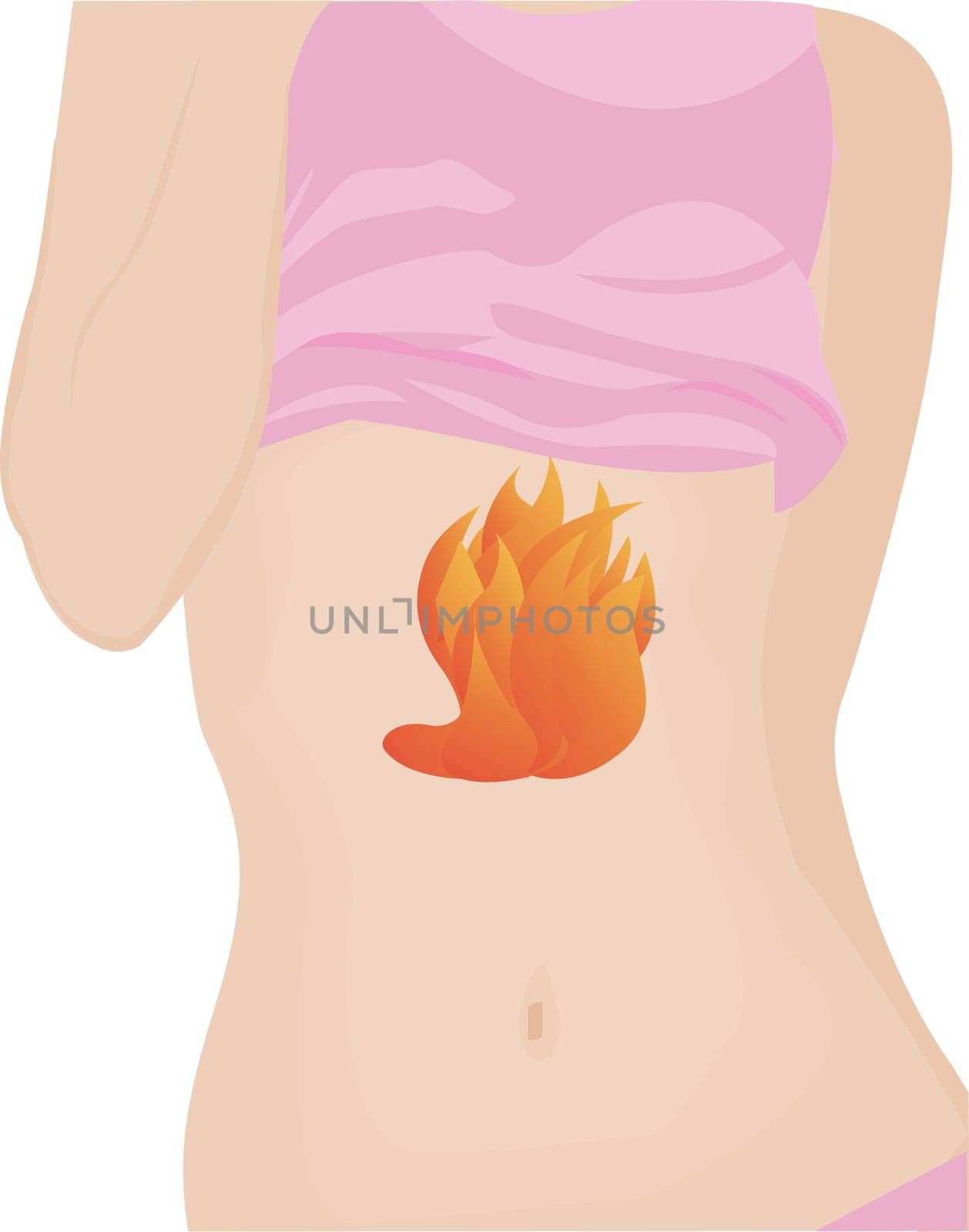 Gastroesophageal reflux disease. Gastritis Heartburn Gerd stomach in a human body vector illustration on a white background