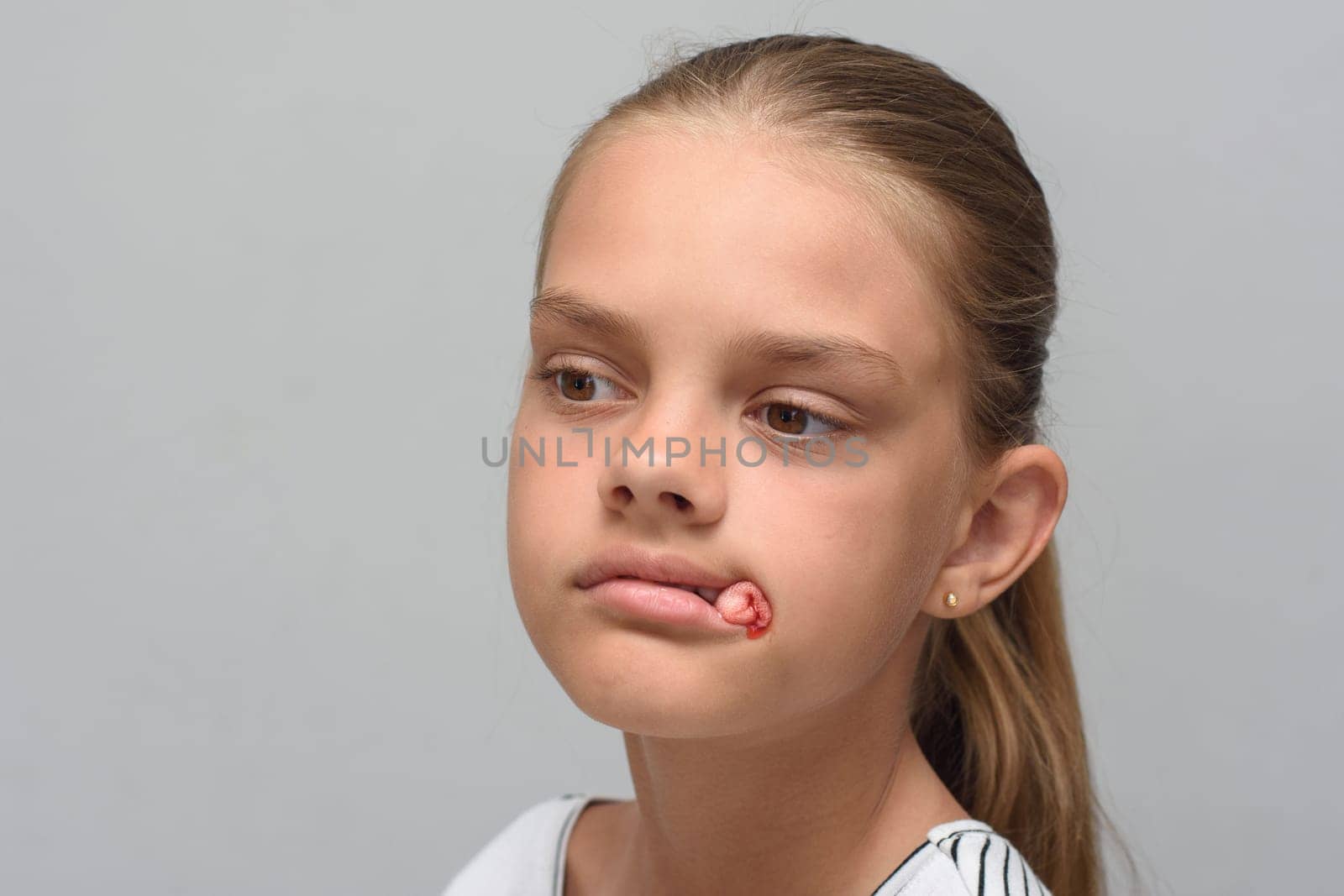 A bloody swab sticks out of the mouth of a ten-year-old girl after tooth extraction