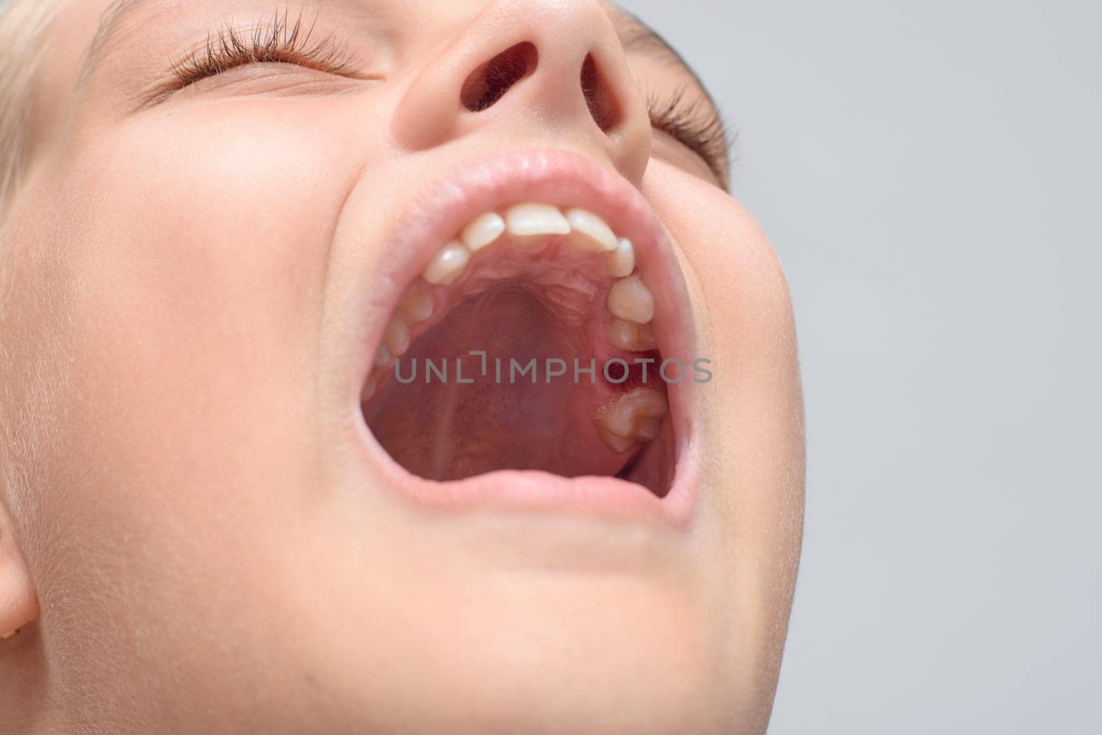 The well after the extraction of the milk tooth in the girl's mouth