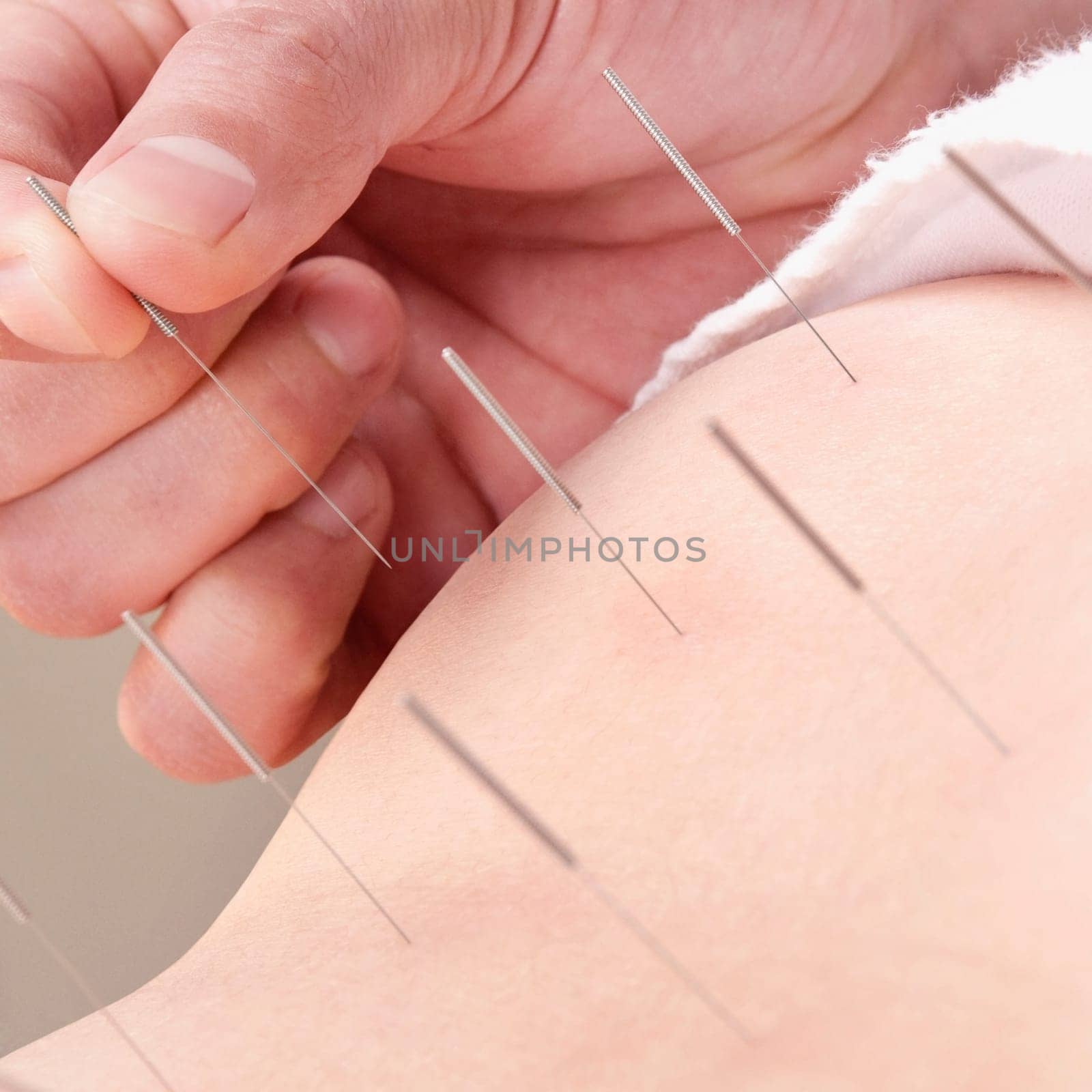 Acupuncturist applying needles on a personŽs back