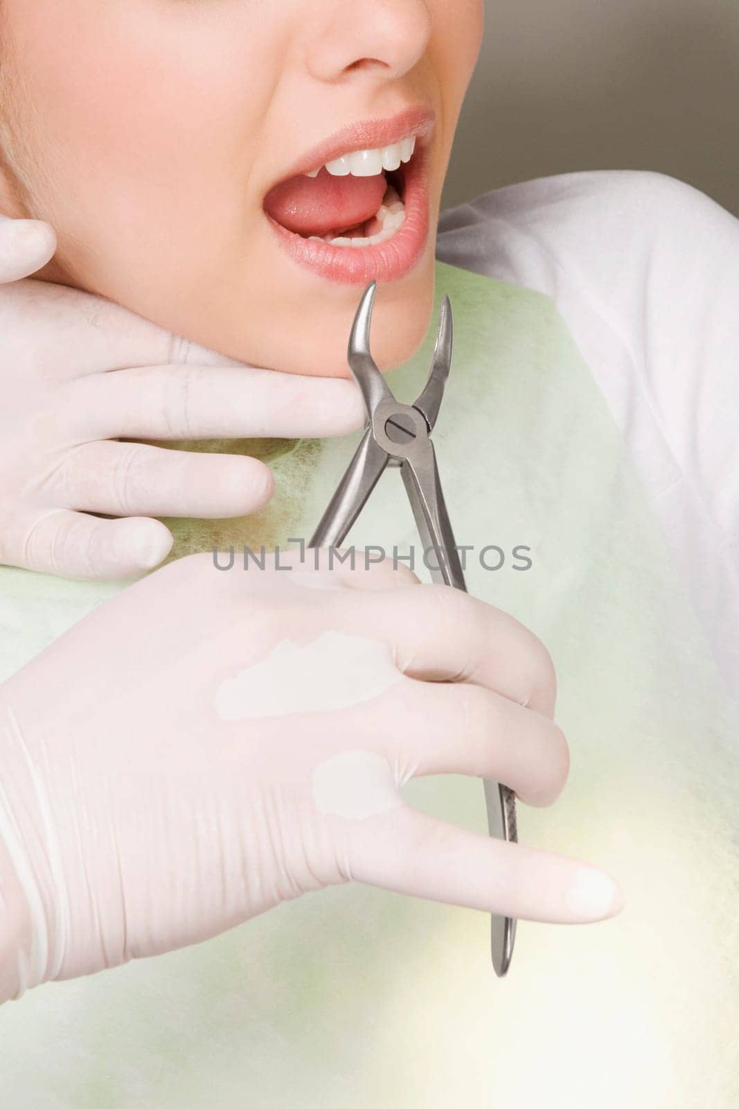 Dentist using pliers to pull out womanŽs teeth