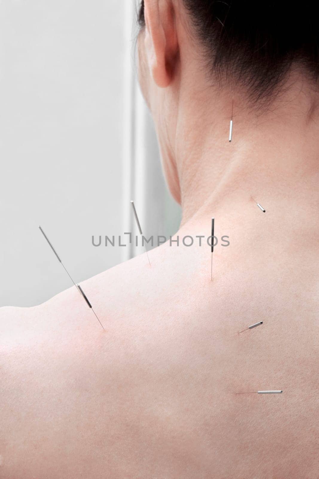 Acupuncture needles on a personŽs back