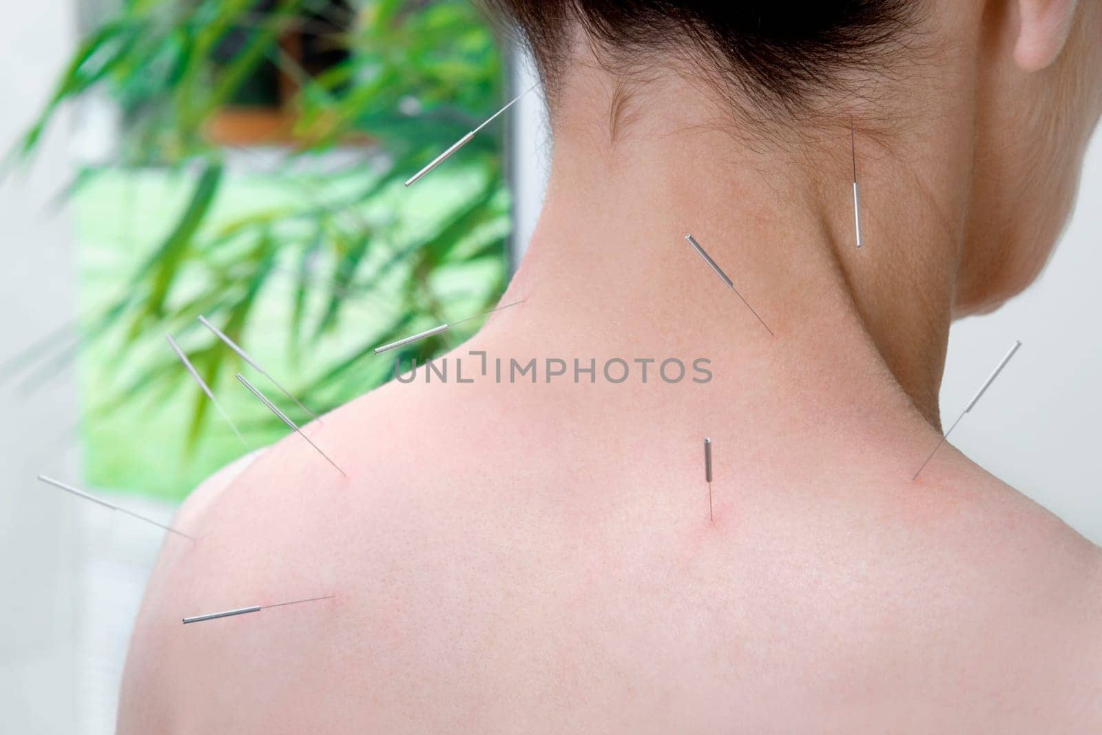 Acupuncture needles on a personŽs back