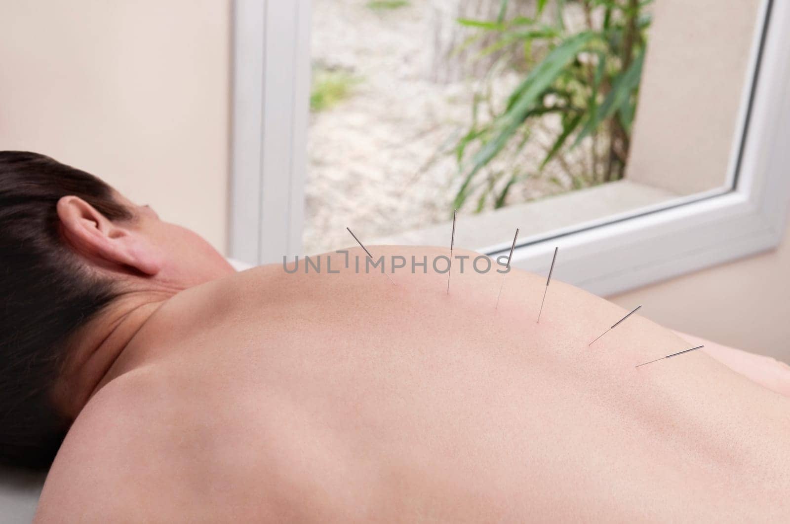 Acupuncture needles on a personŽs back