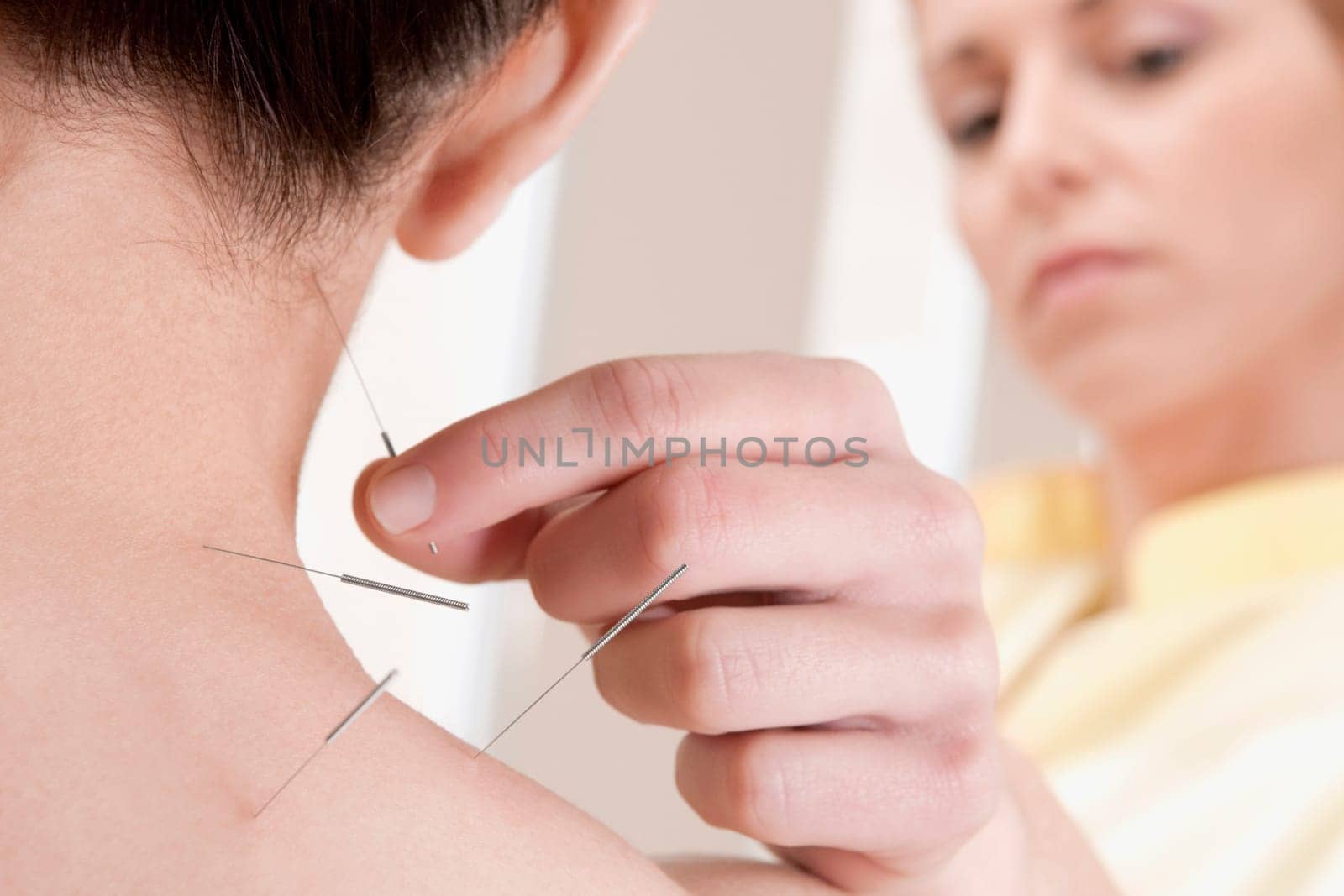 Acupuncturist applying needles on a personŽs back