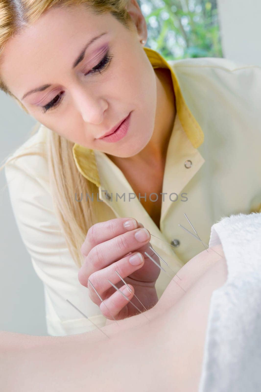 Acupuncturist applying needles on a personŽs back