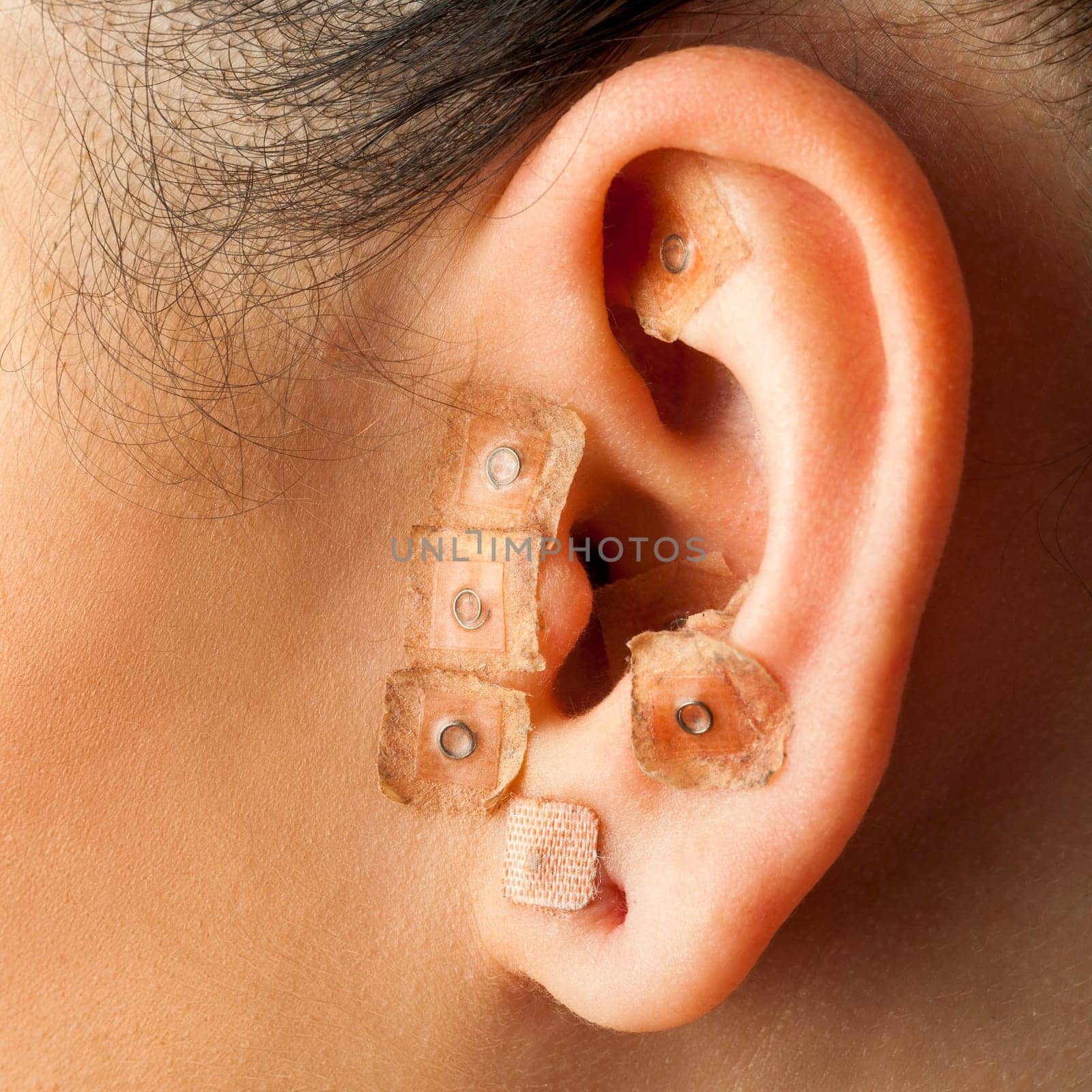 Macro close up of auriculotherapy treatment on human ear.