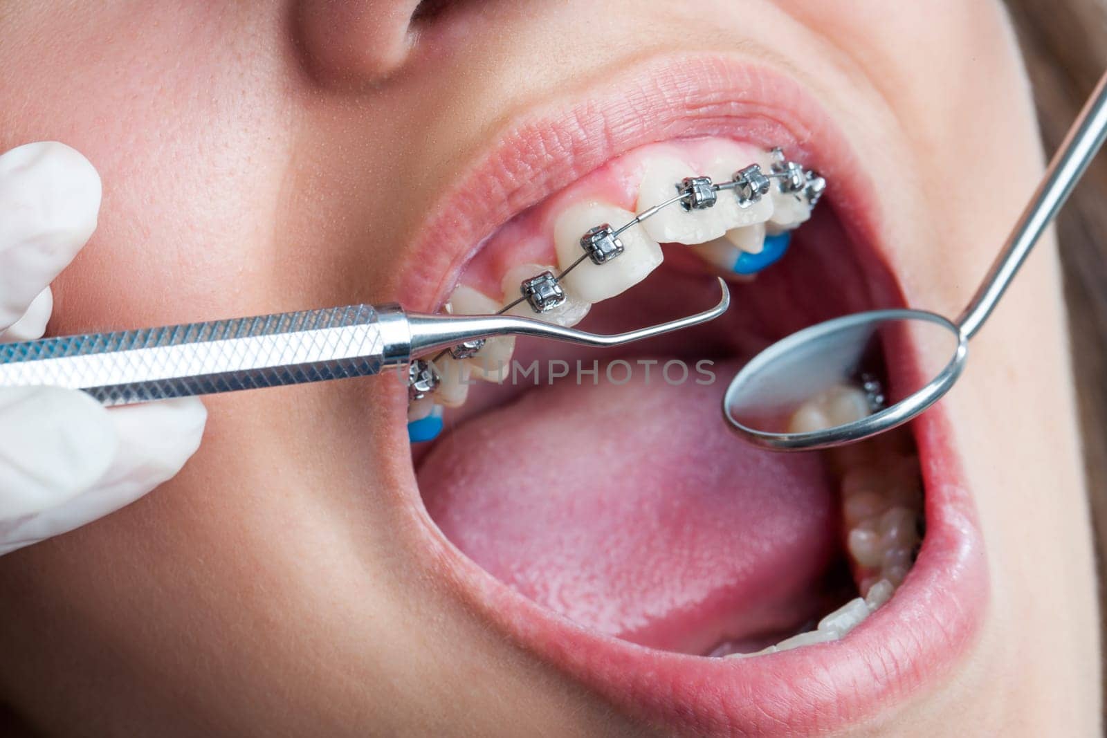 Extreme macro close up of open human mouth showing stainless steel braces.