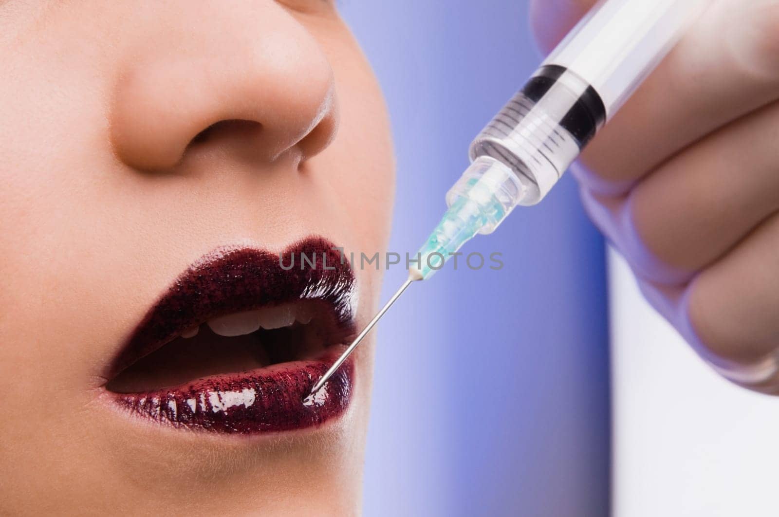 Close_up of a surgeonŽs hand injecting on lips of a young woman