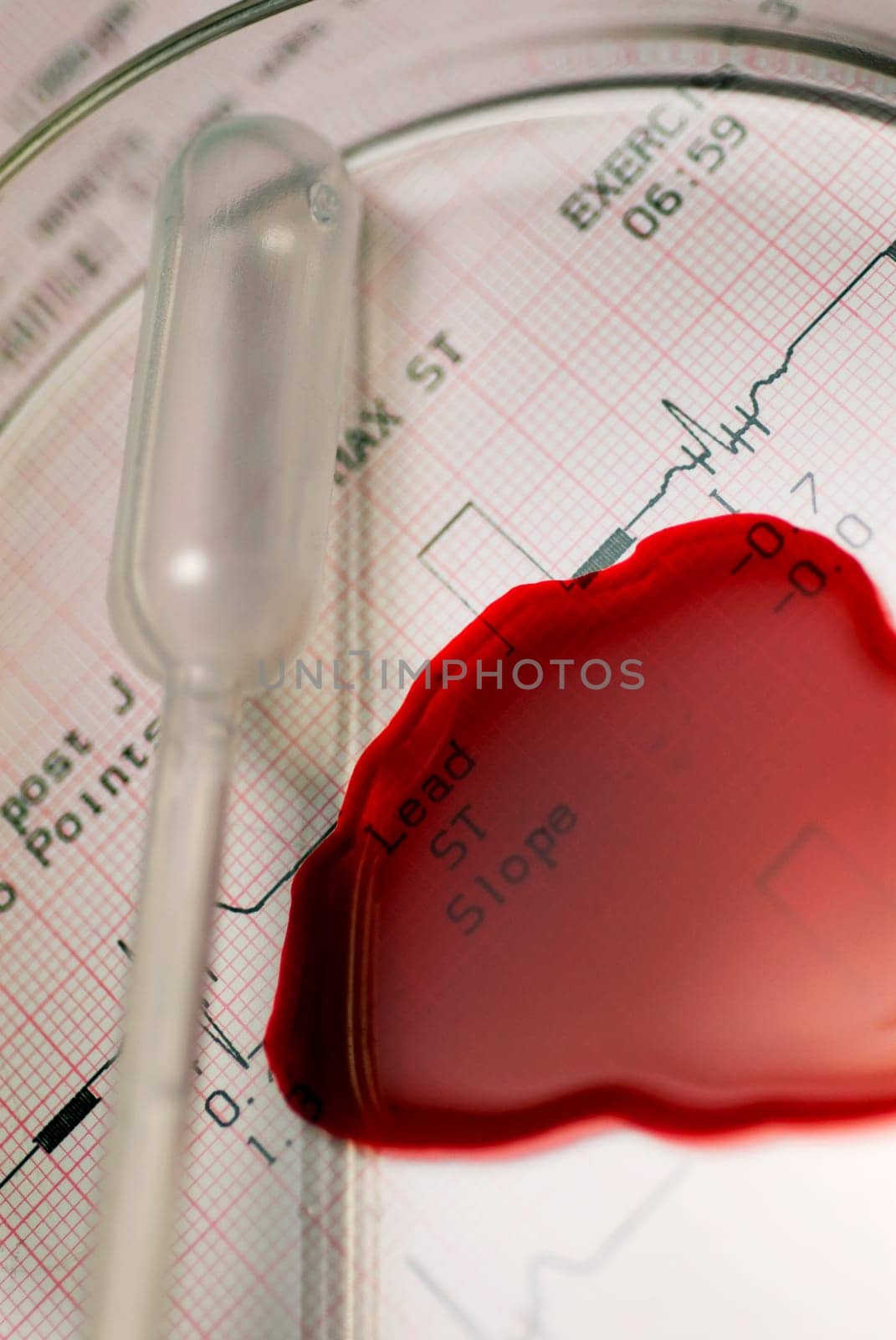 Close_up of a pipette with blood on an electro cardiogram report