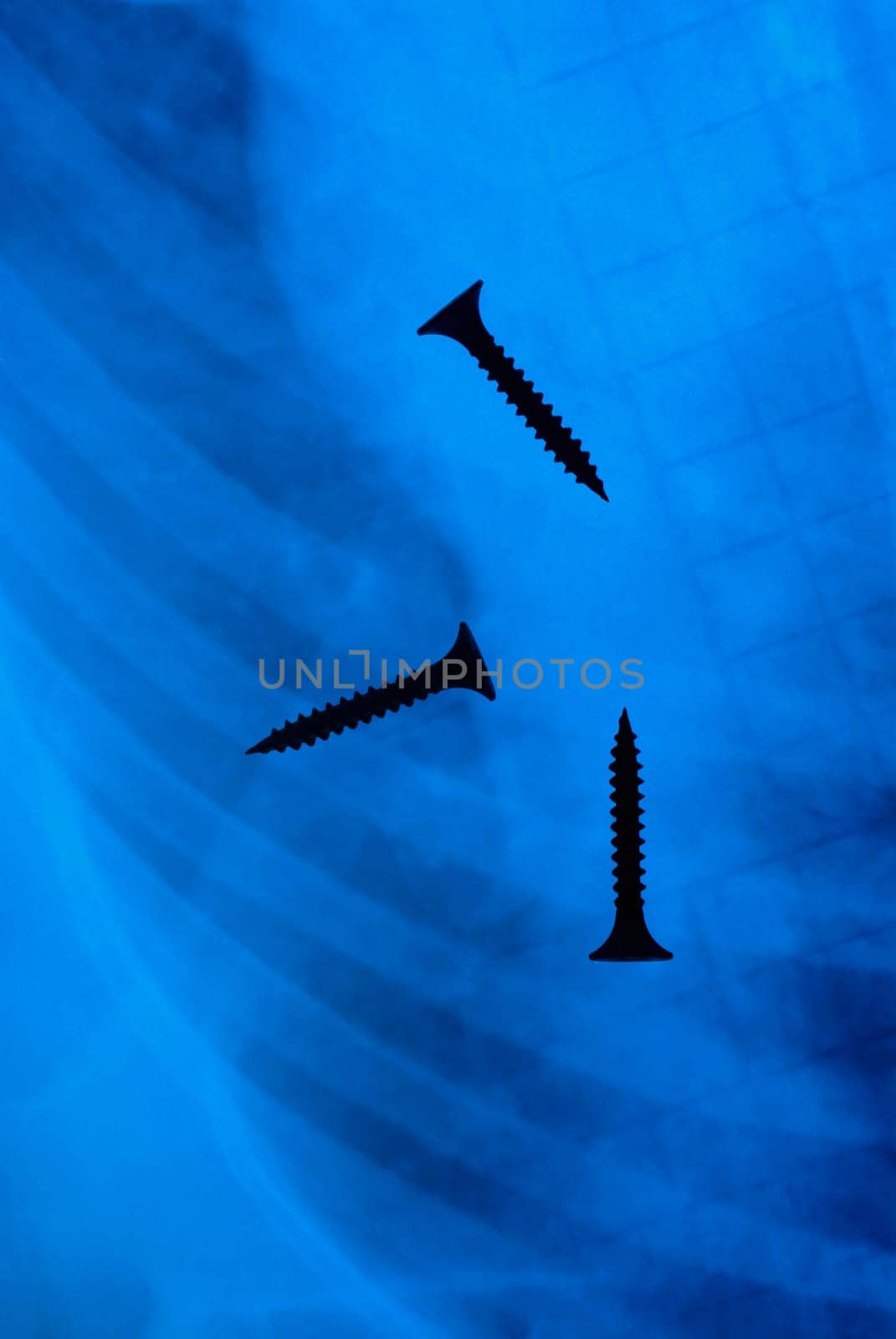 Three screws shown in an X_ray report