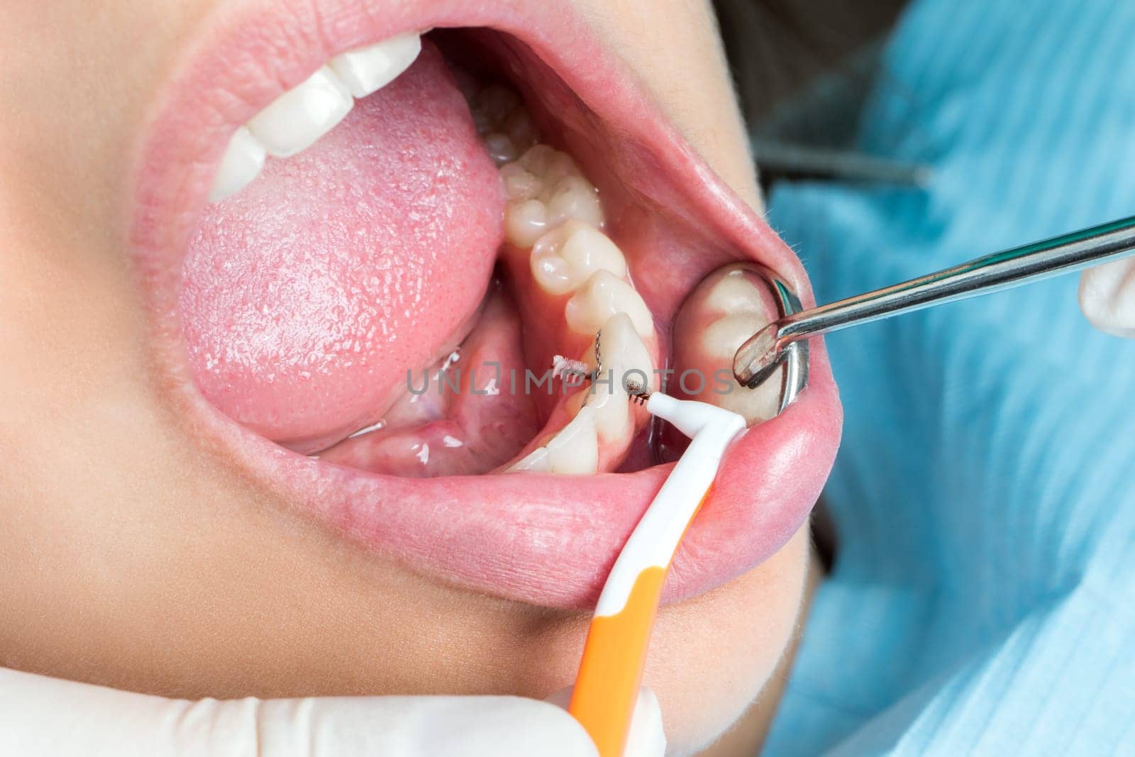 Macro close up of hands doing interdental cleaning on human teeth.Human mouth wide open with interdental brush between teeth.