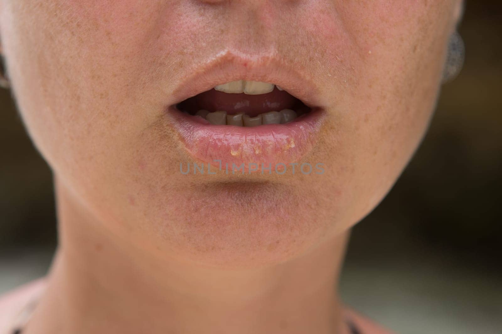 Close-up of female lips suffering from herpes disease
