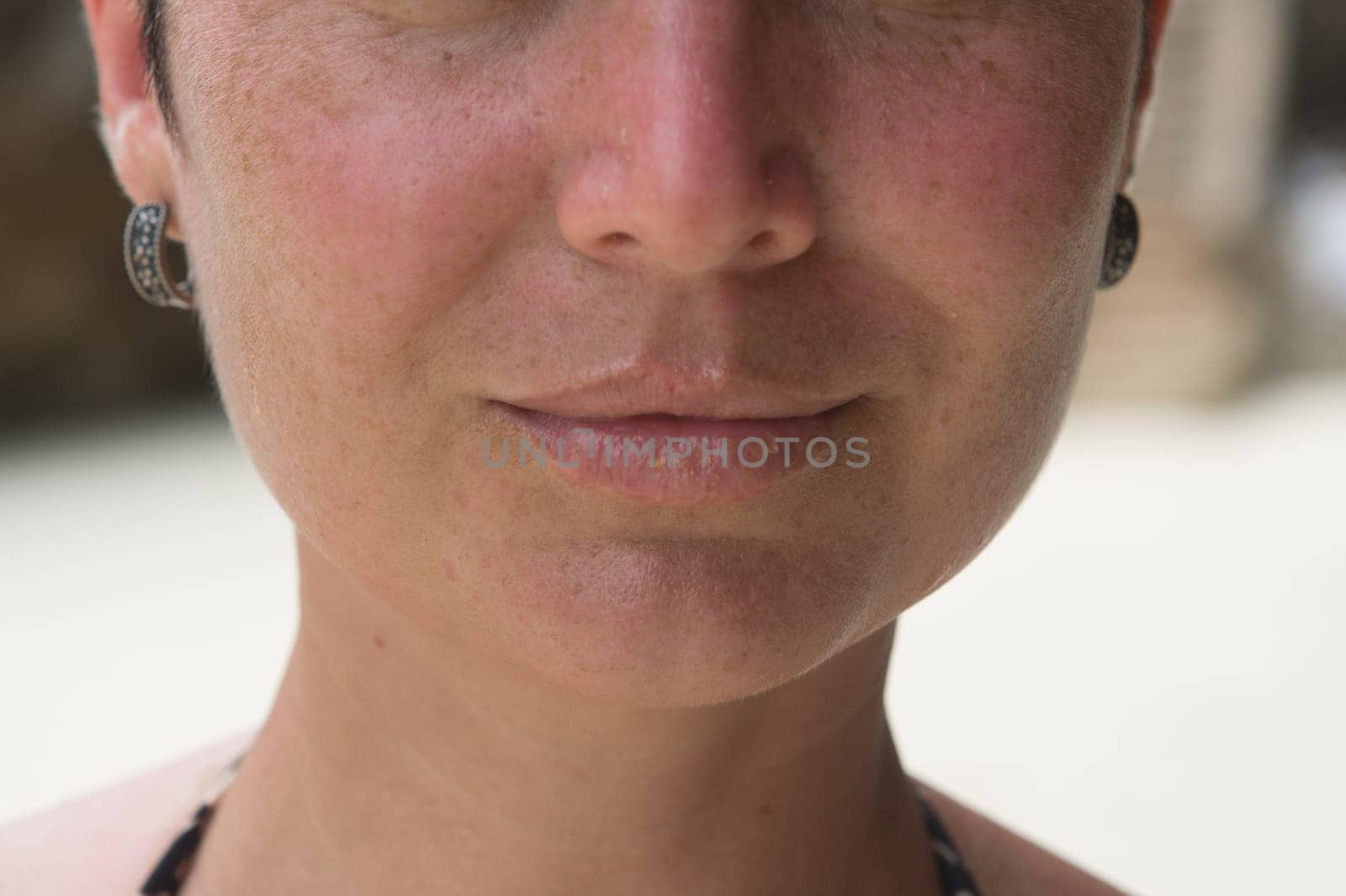Close-up of female lips suffering from herpes disease