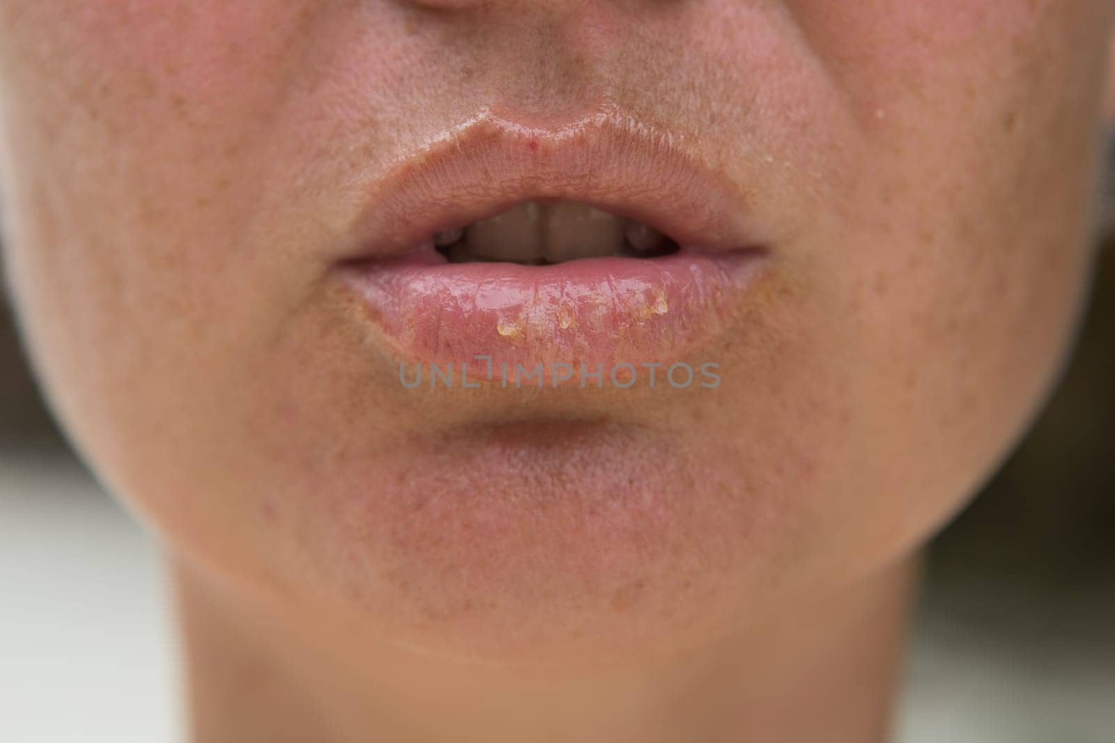 Close-up of female lips suffering from herpes disease