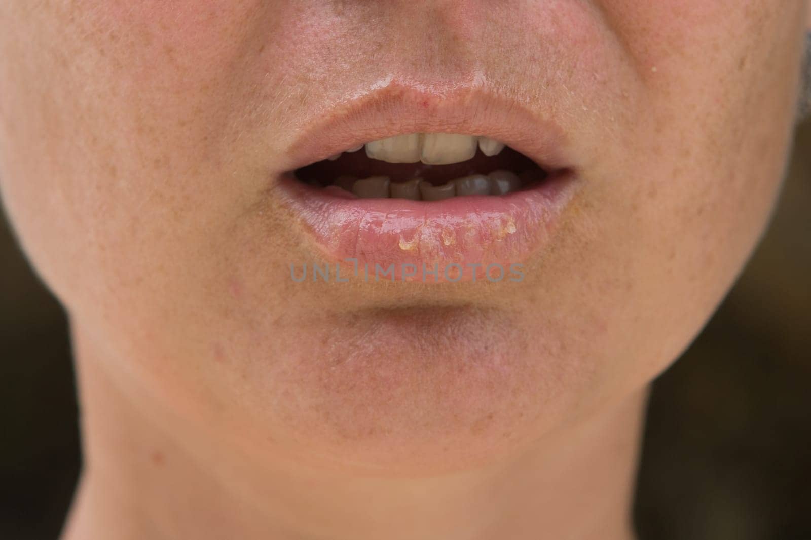 Close-up of female lips suffering from herpes disease