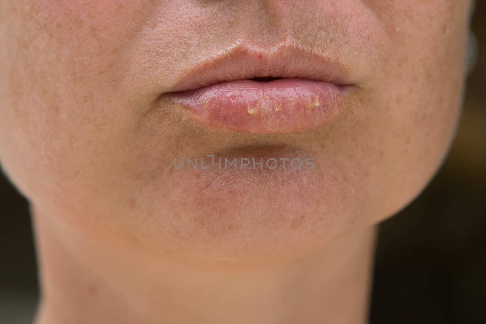 Close-up of female lips suffering from herpes disease
