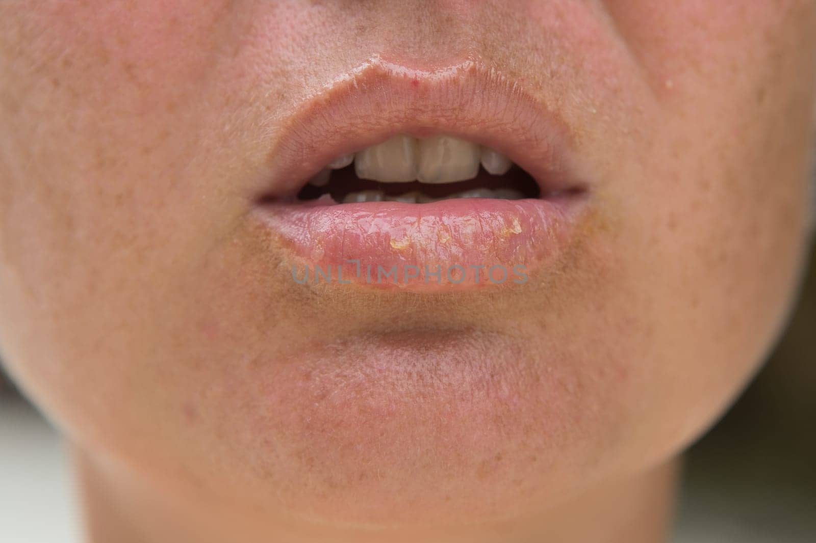 Close-up of female lips suffering from herpes disease