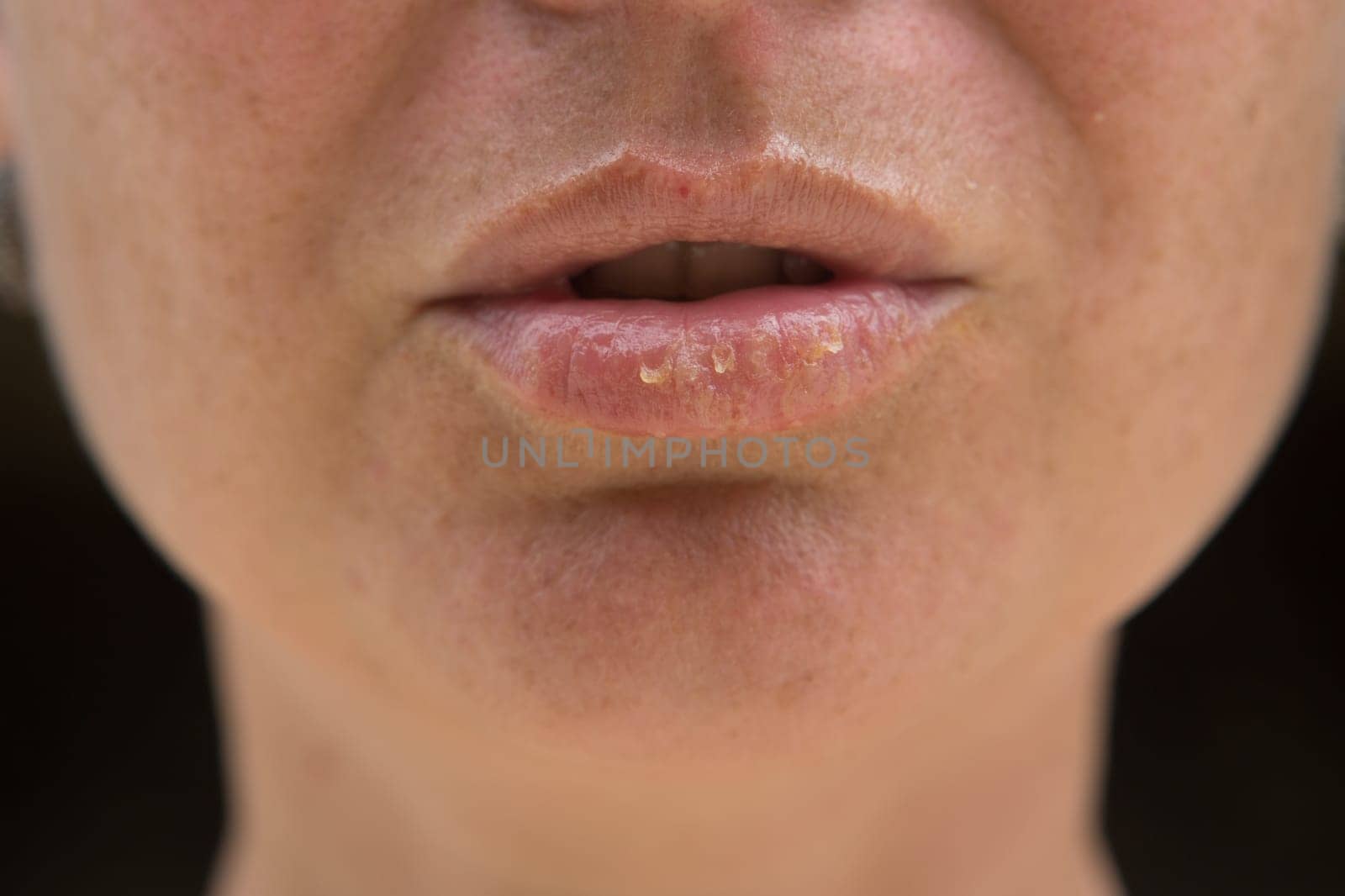 Close-up of female lips suffering from herpes disease