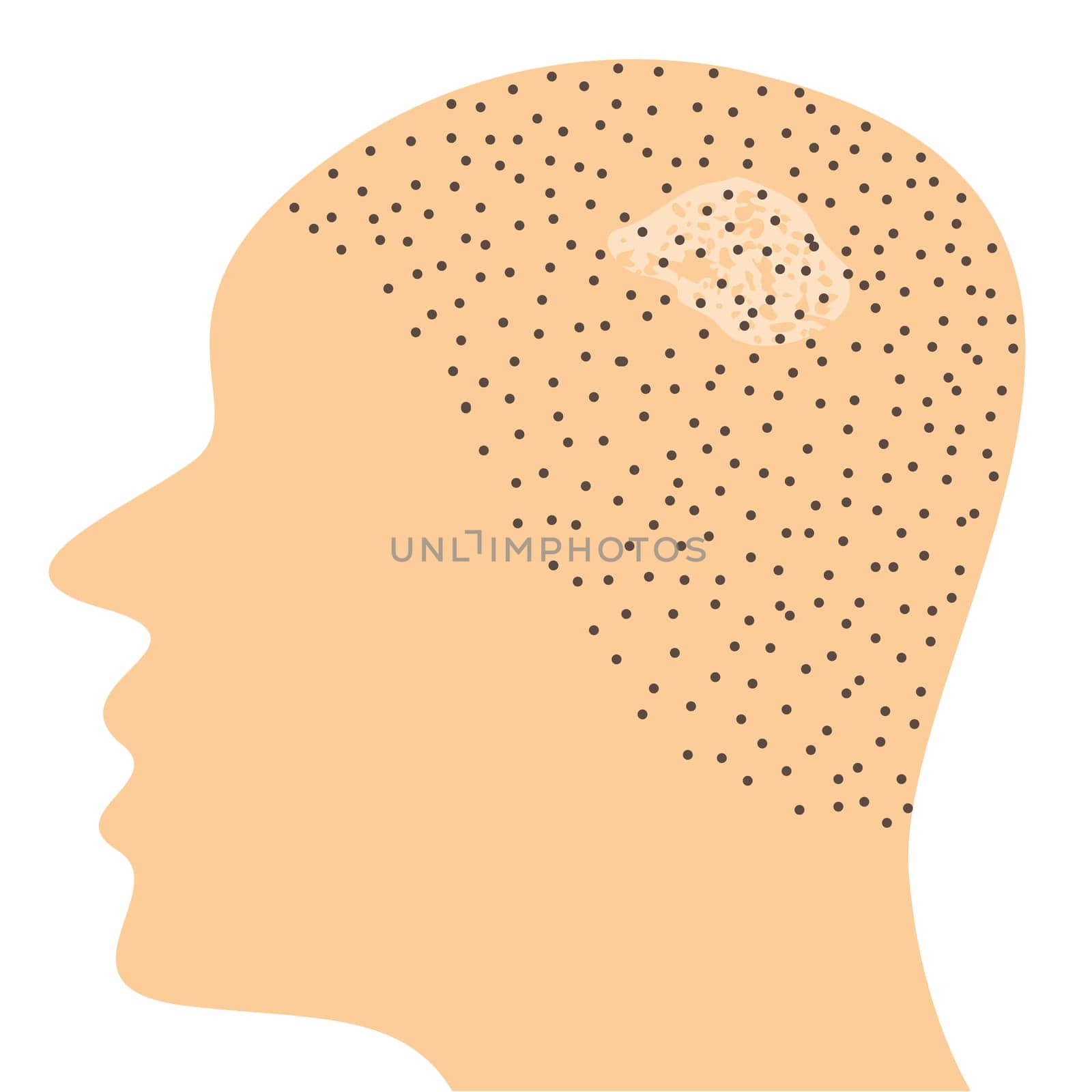 Fungal infection on scalp head vector illustration