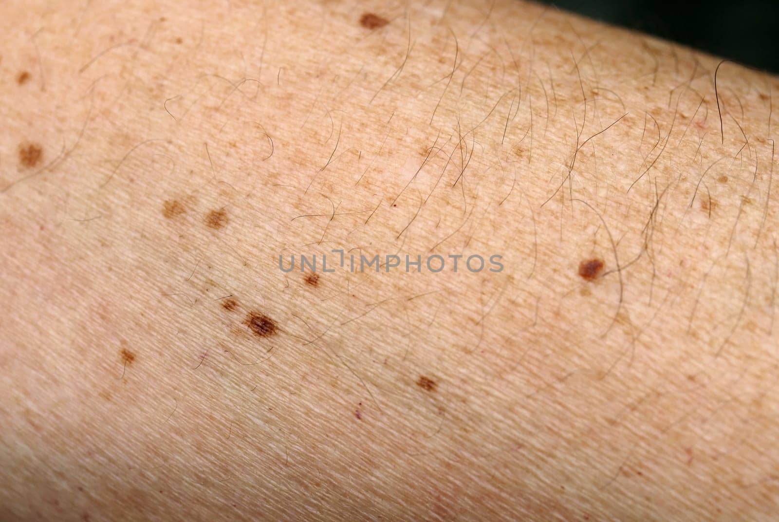 Dangerous or harmless pigment spots on the skin