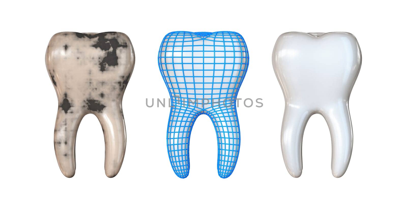 Stages of tooth healing 3D render illustration isolated on white background