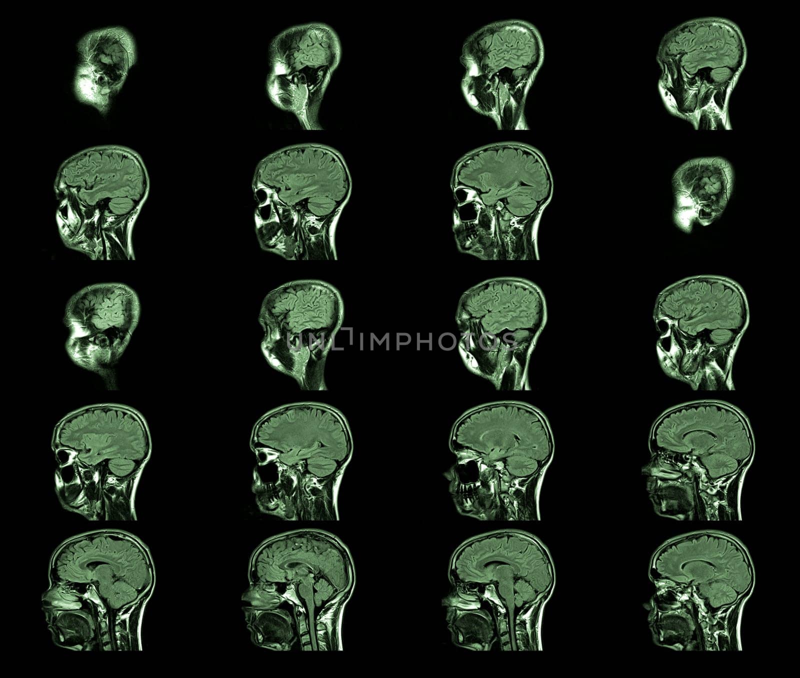magnetic resonance imaging, MRI MRT head