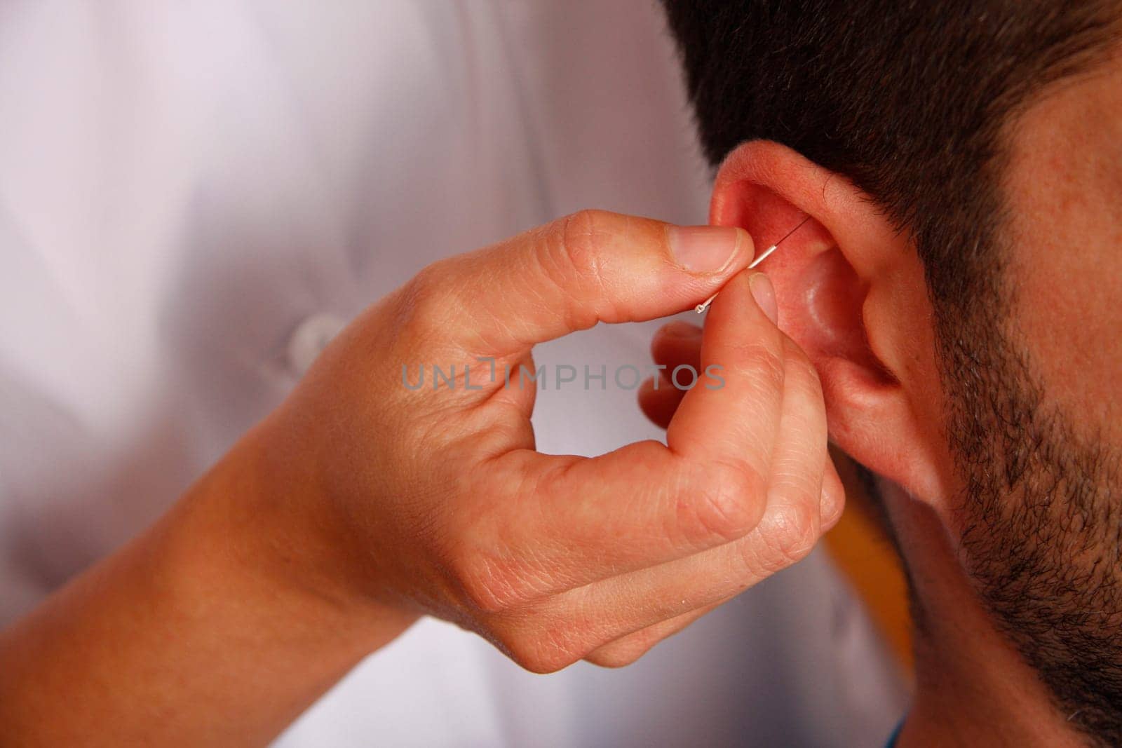 Acupunture cupping is a  Chinese Medicine Procedure