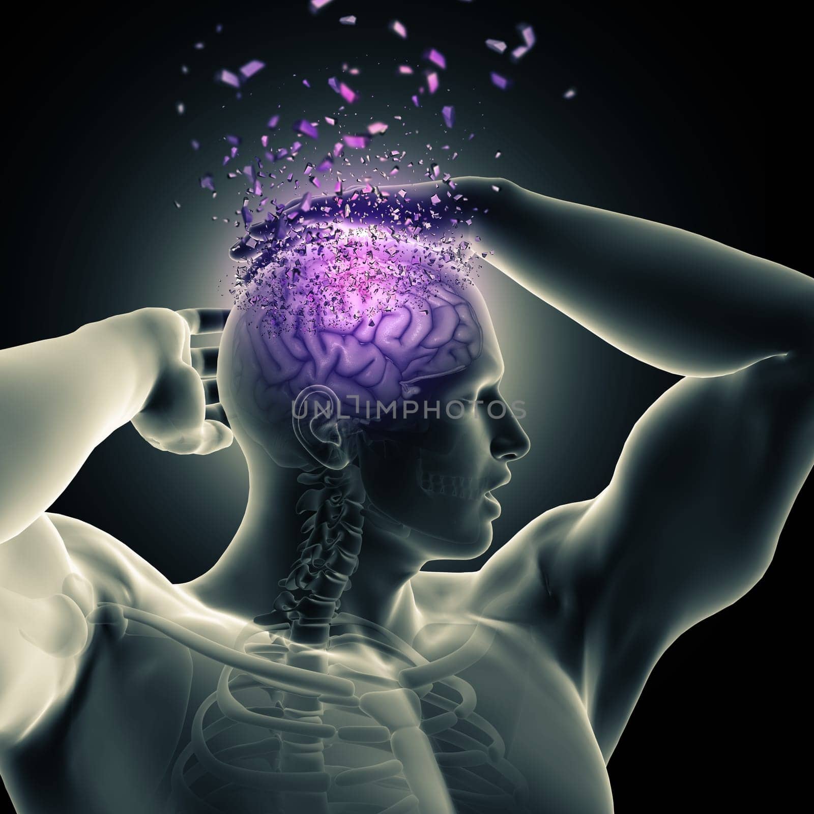 3D render of a male figure holding head with brain shattering depicting mental health issues