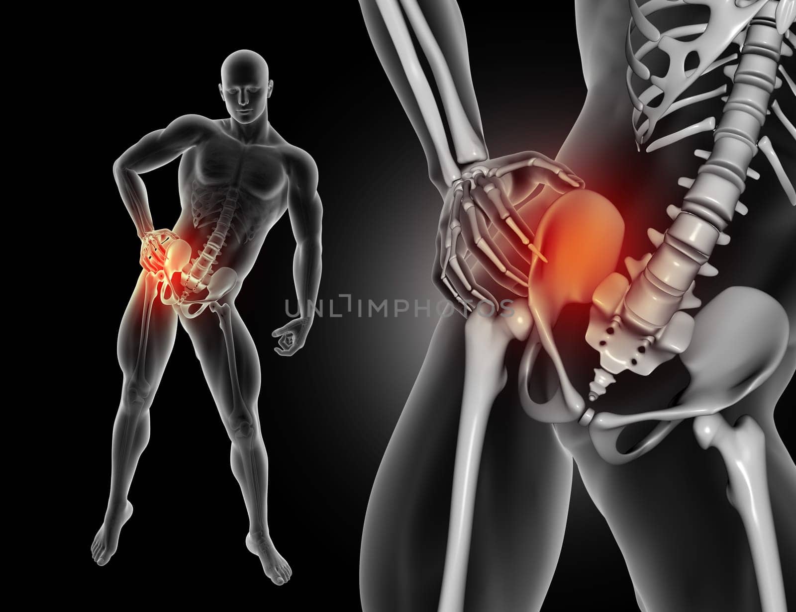 3D render of a male figure holding hip in pain with close up of hip bone