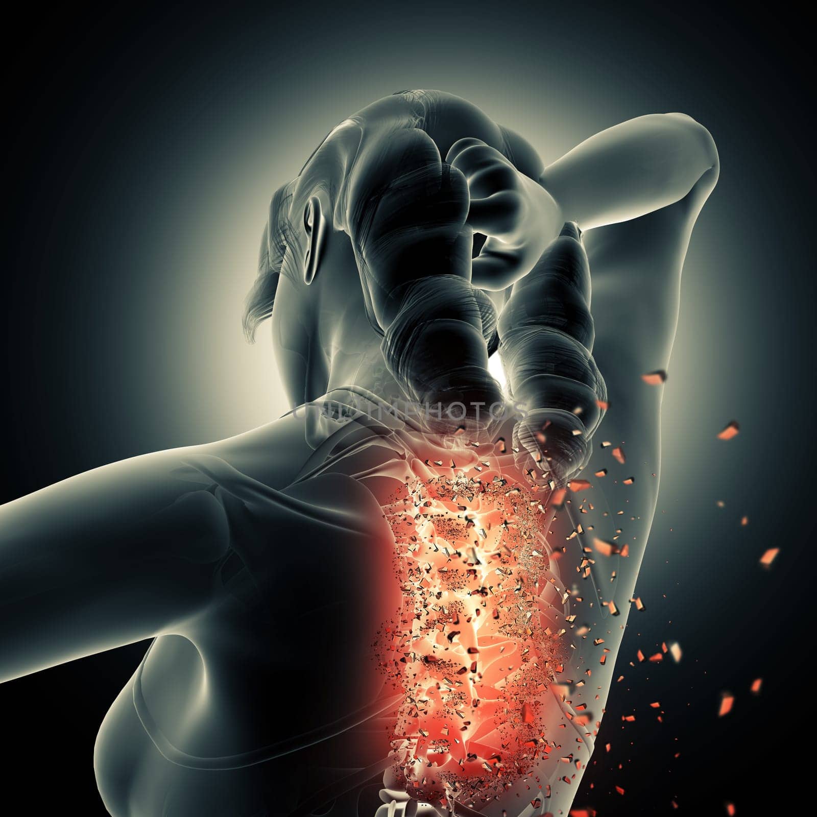 3D render of a medical background with female figure with spine shattering
