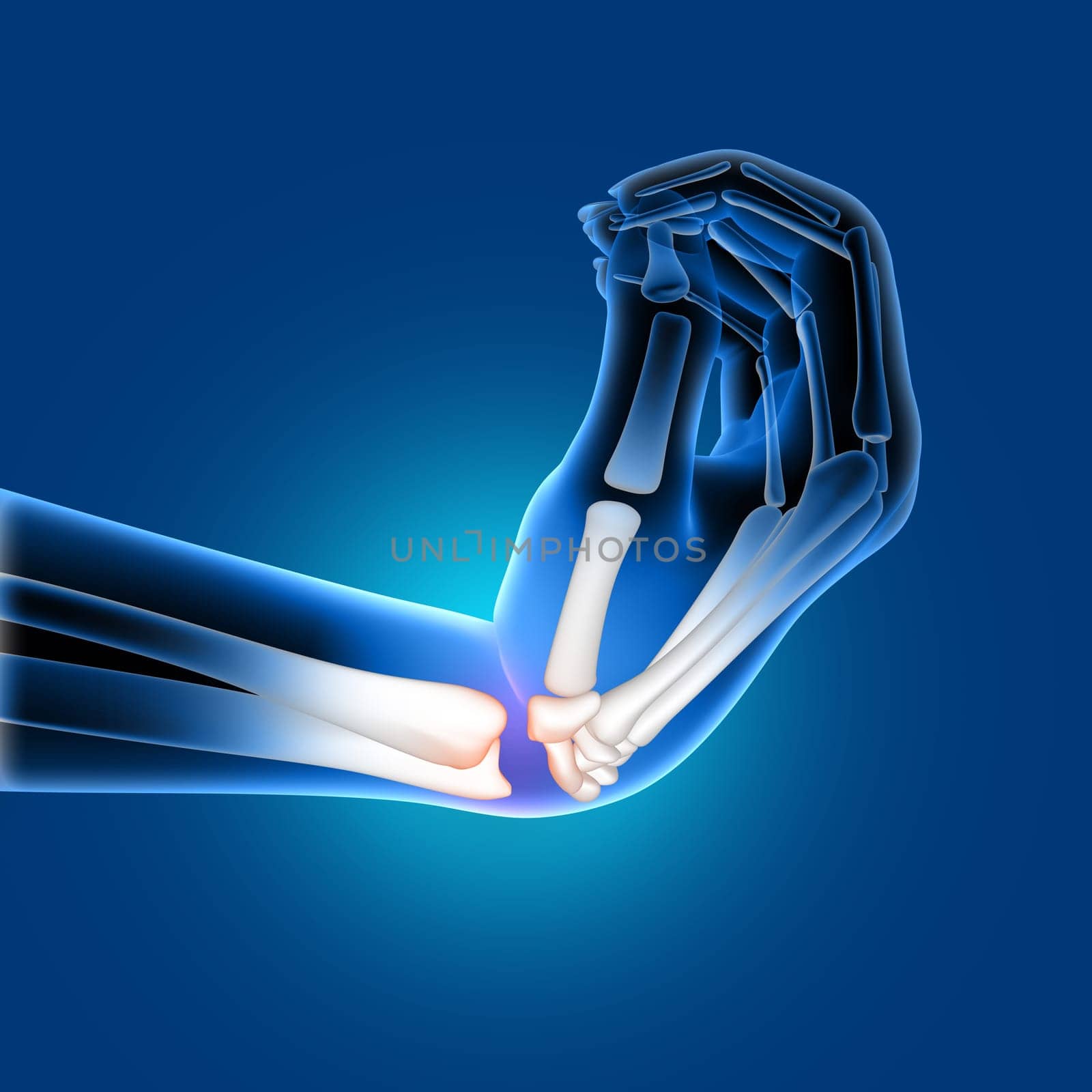 3D render of a medical image of a painful bent wrist