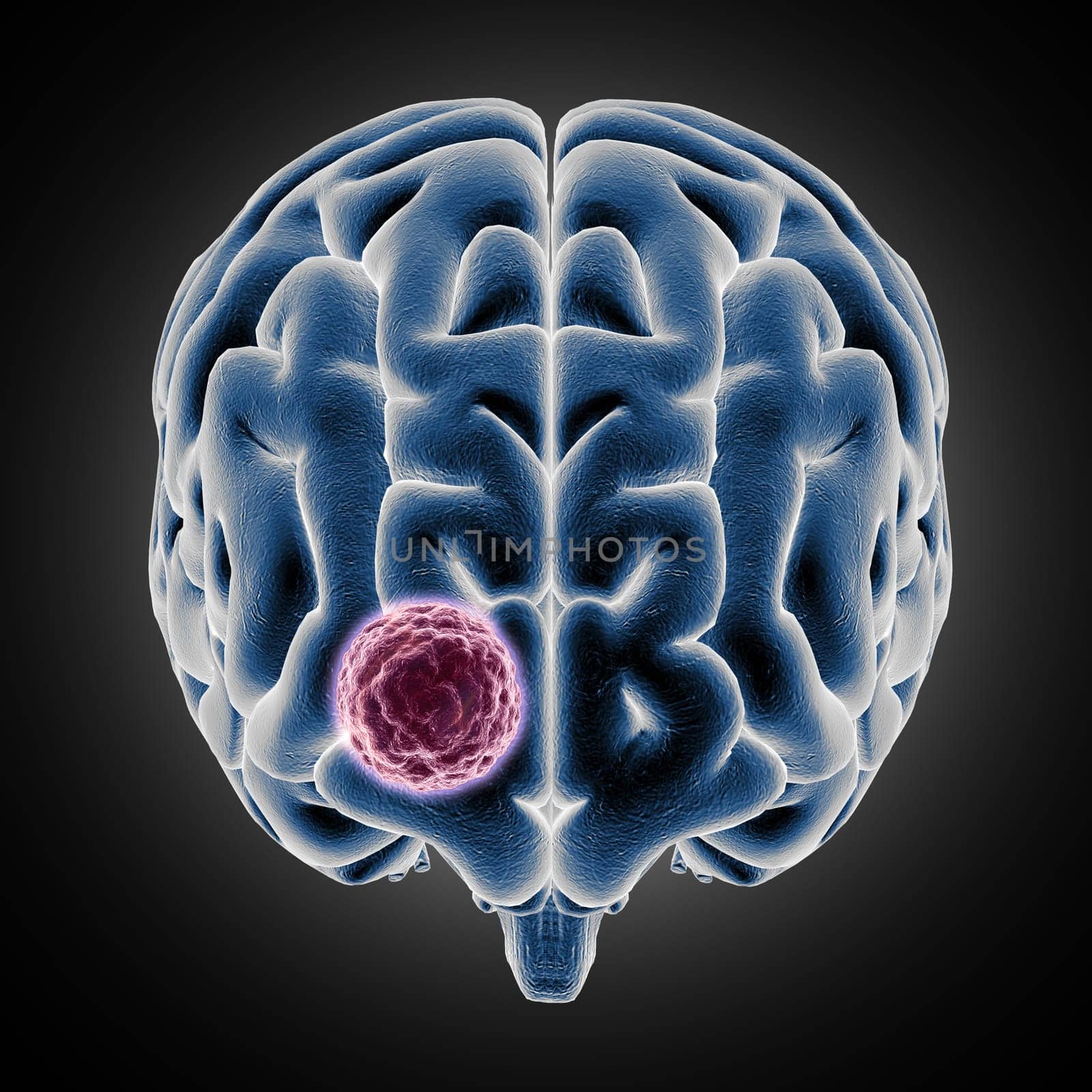 3D render of a medical image showing brain with tumor growing