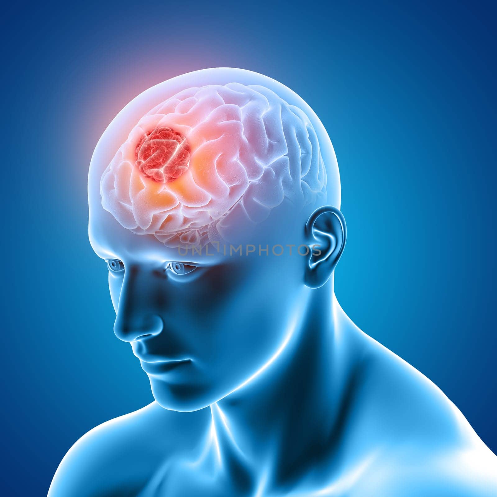 3D render of a medical image showing male figure with brain tumour